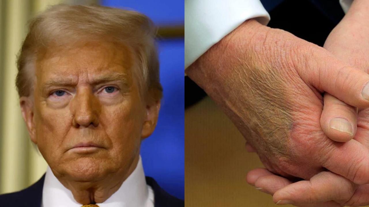 Záhadná modrina na Trumpovej ruke.