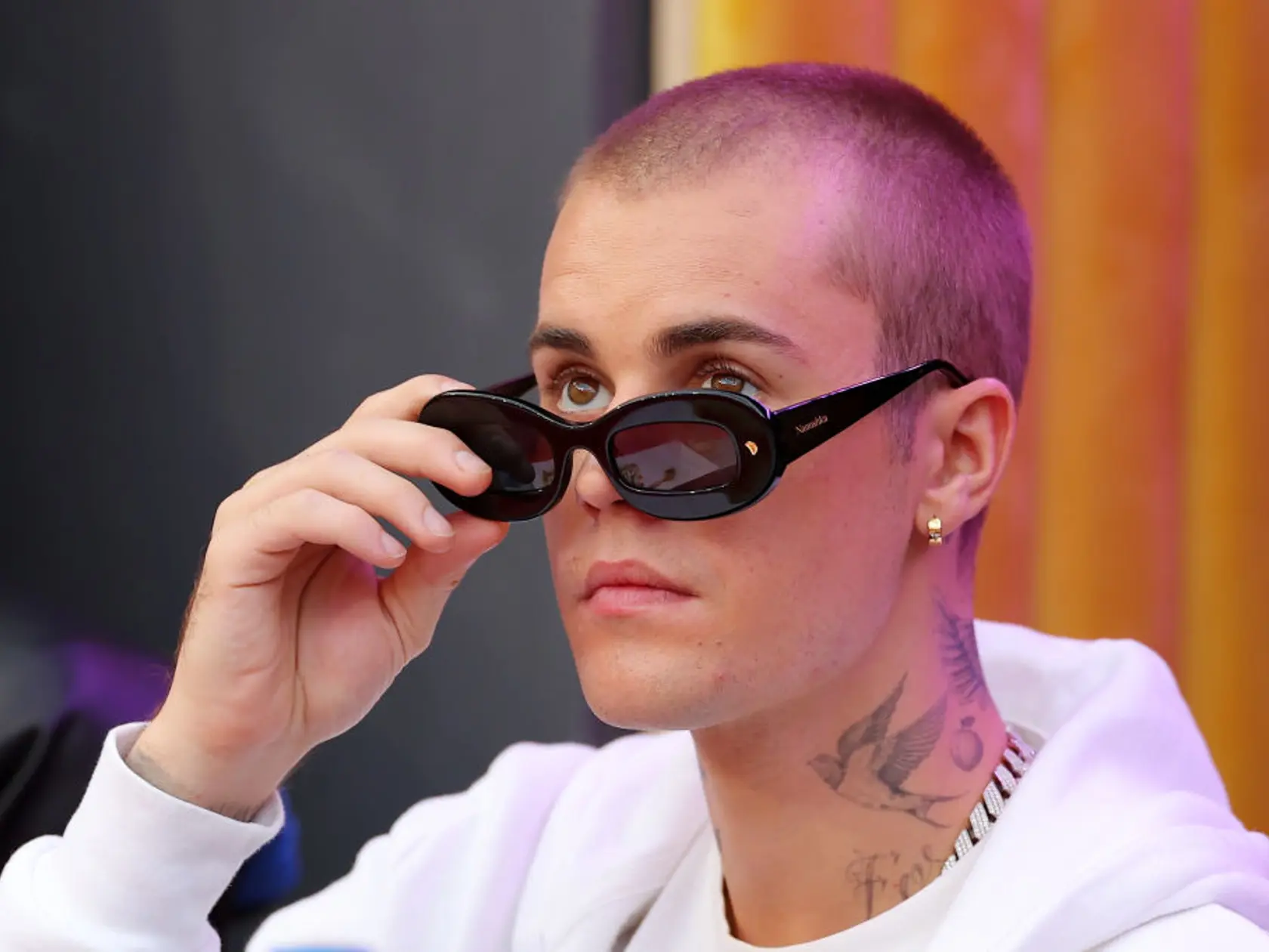 Plastický chirurg Dr. Gary Linkov naznačil, že spevák Justin Bieber podstúpil transplantáciu vlasov. Na starých fotkách mu totiž vidieť „kúty“.