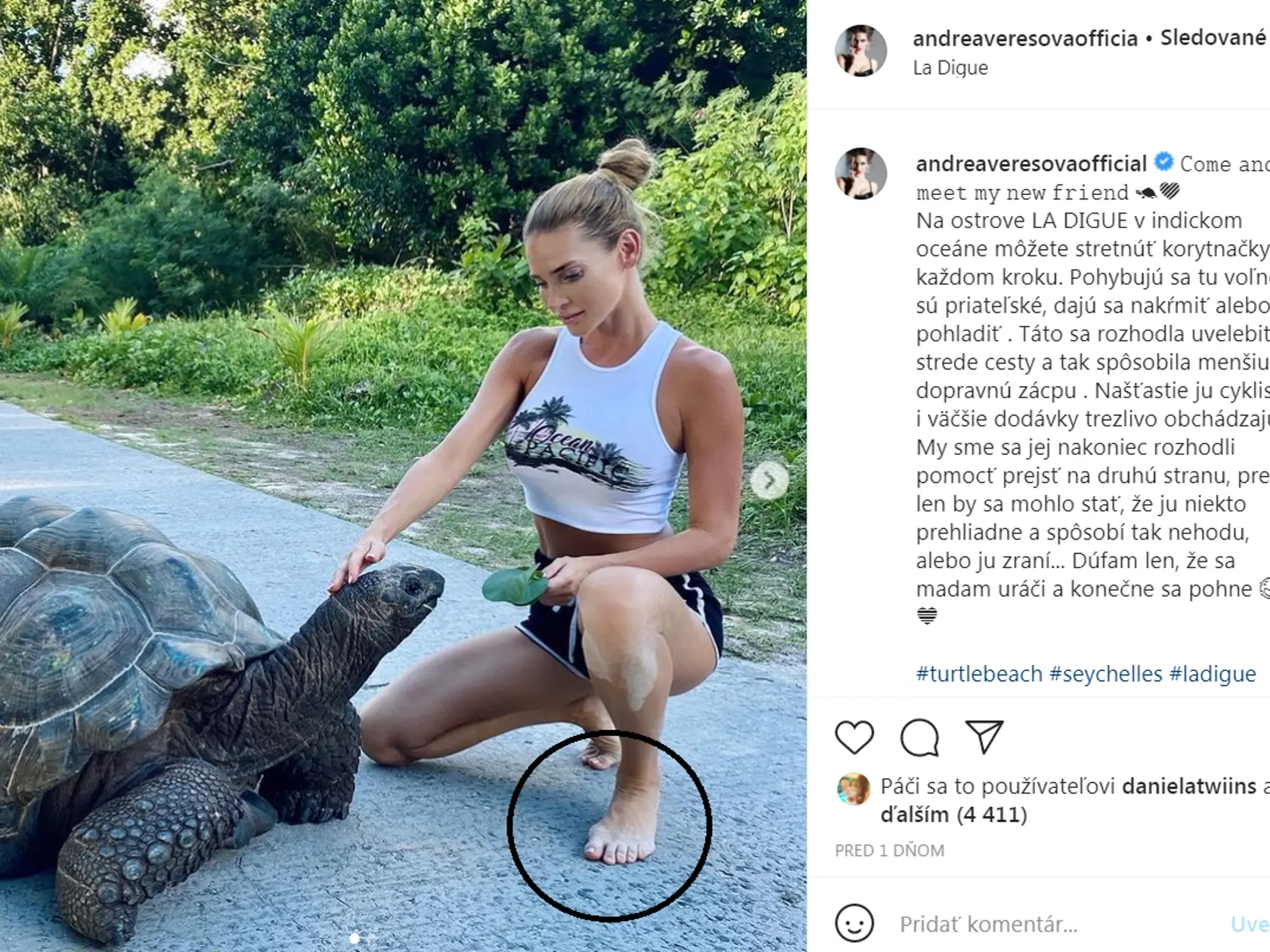 Andrea Verešová - naozaj jer komplikujú život takzvané kladivkoévé prsty?
