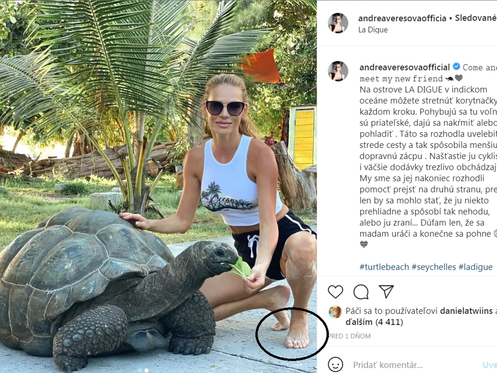 Andrea Verešová - naozaj jej komplikujú život kladivkové prsty?