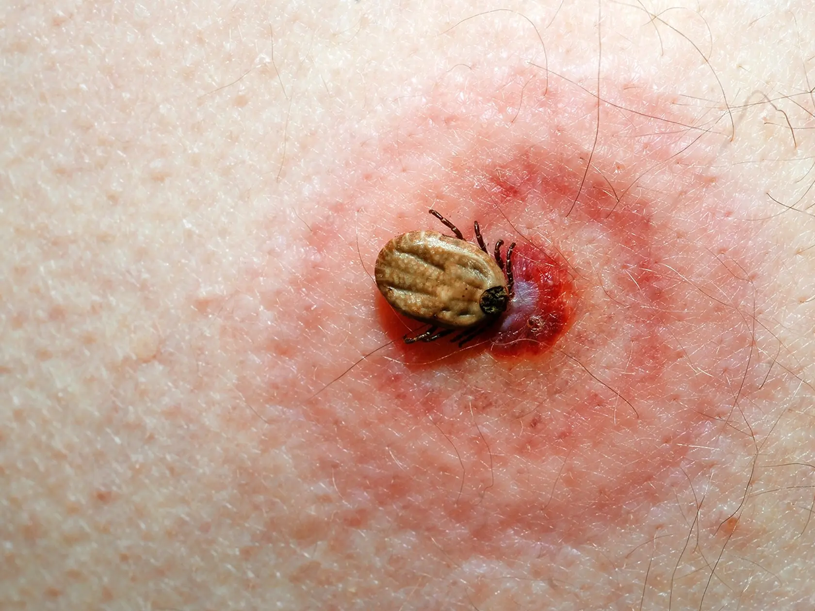 Nie všetky kliešte sú nakazené, riziko pri uhryznutí je však  vždy prítomné.