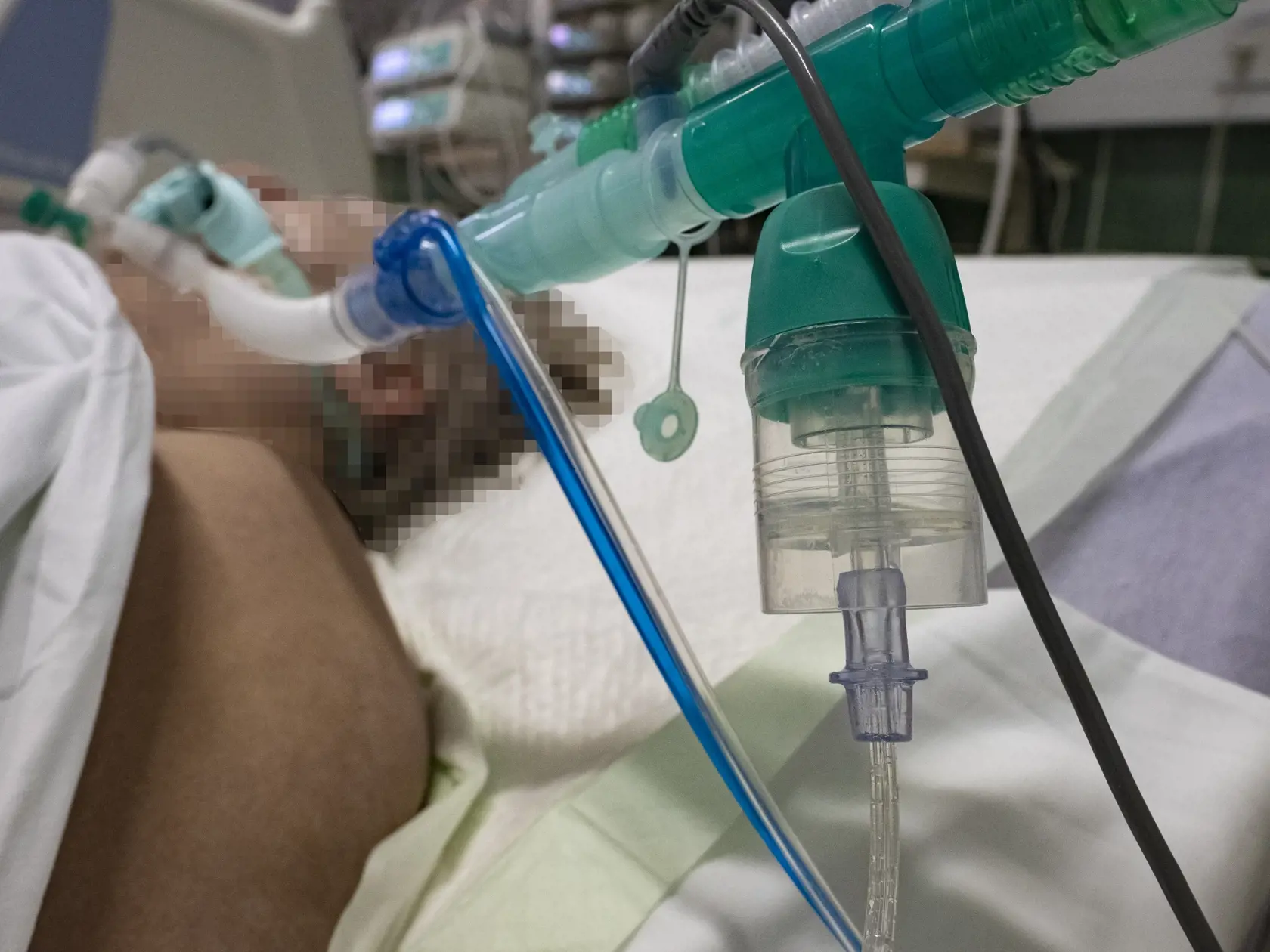 Situácia na anesteziologicko-resuscitačnom oddelení nemocnice svätého Cyrila a Metoda v Bratislave si vyžiadala zriadenie špeciálnej sekcie, kde sa nepretržite starajú o pacientov nakazených koronavírusom Covid - 19. 