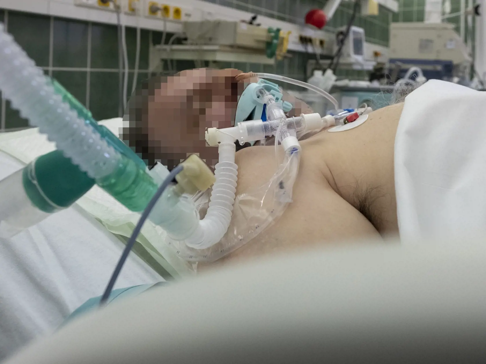 Situácia na anesteziologicko-resuscitačnom oddelení nemocnice svätého Cyrila a Metoda v Bratislave si vyžiadala zriadenie špeciálnej sekcie, kde sa nepretržite starajú o pacientov nakazených koronavírusom Covid - 19. 