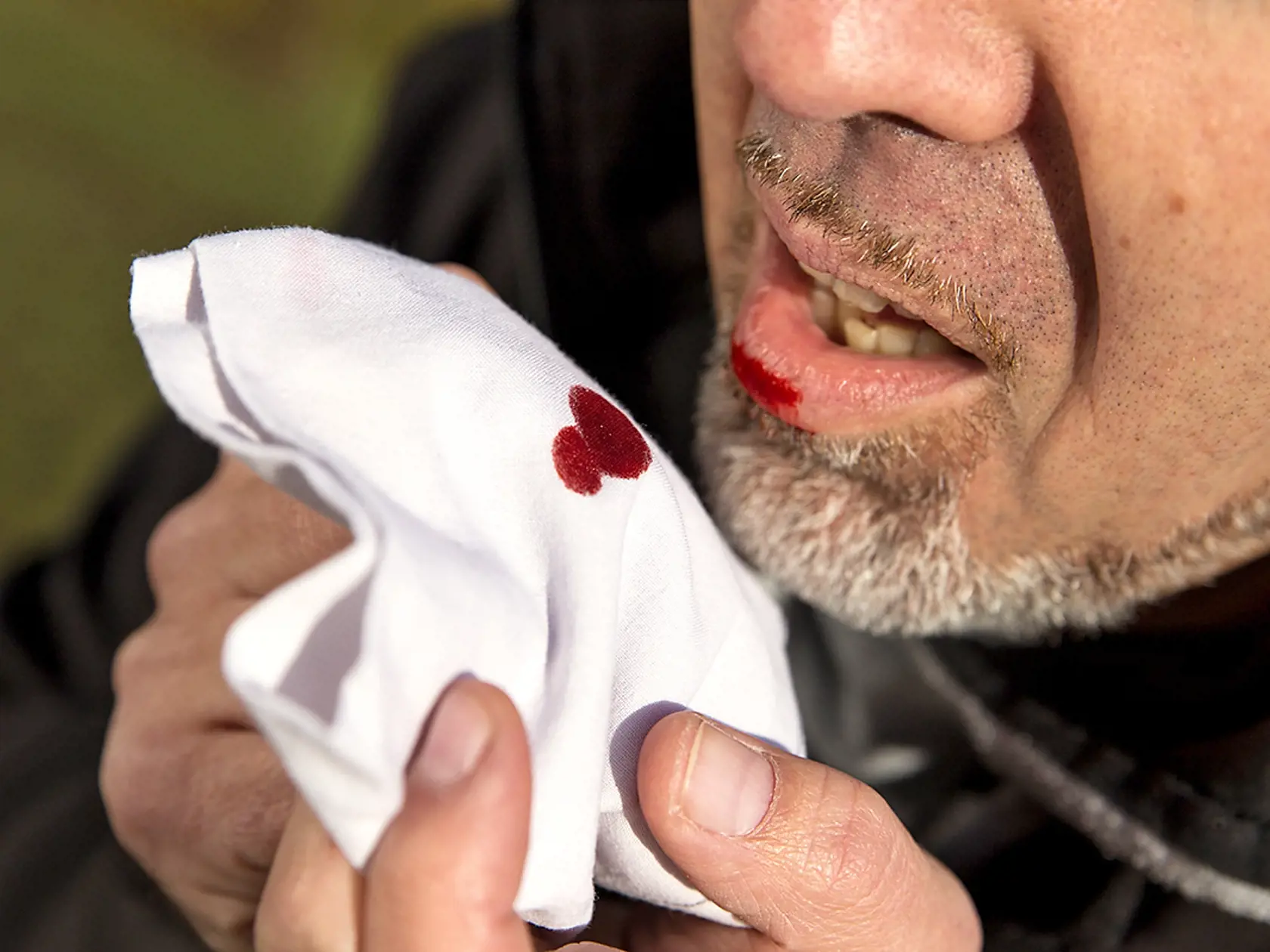 Vykašliavanie krvi môže byť príznakom pokročilej rakoviny pľúc.