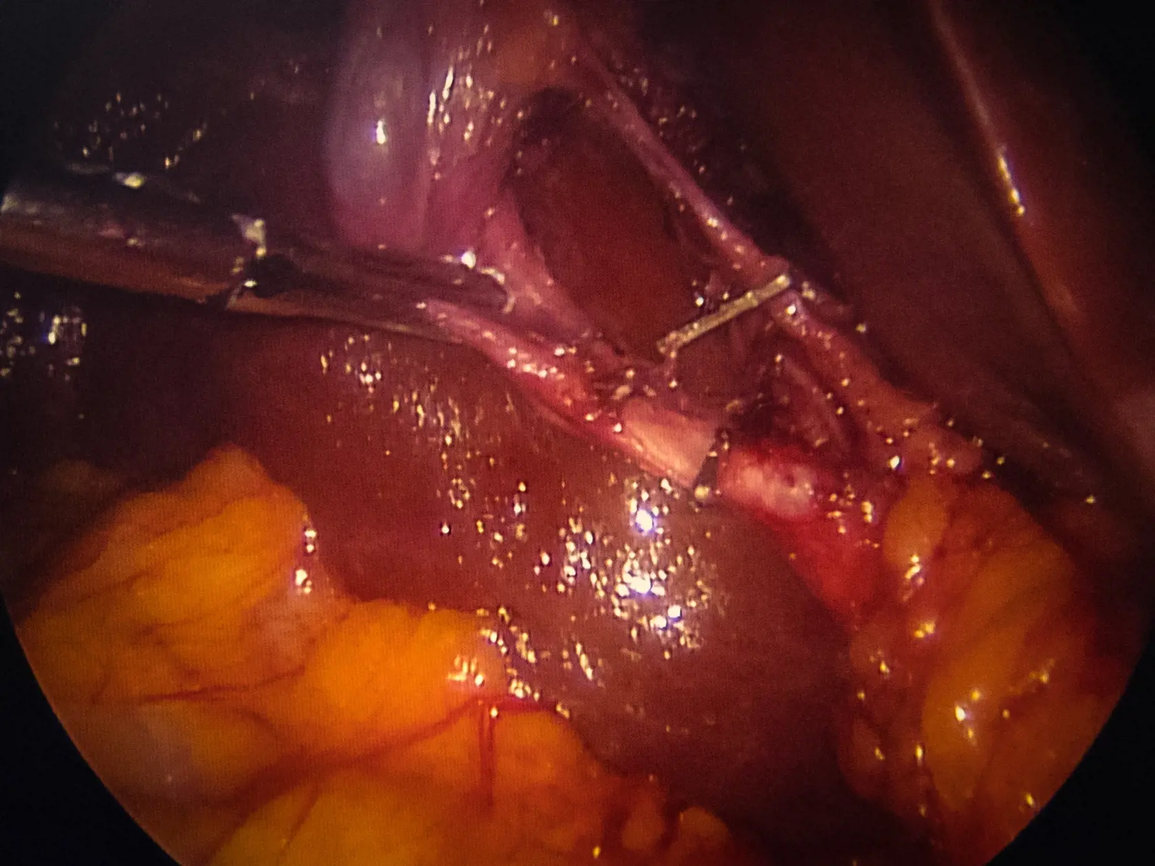 Laparoskopická operácia odstránenia žlčníka na klinike jednodňovej chirurgie REVIVE v Bratislave.