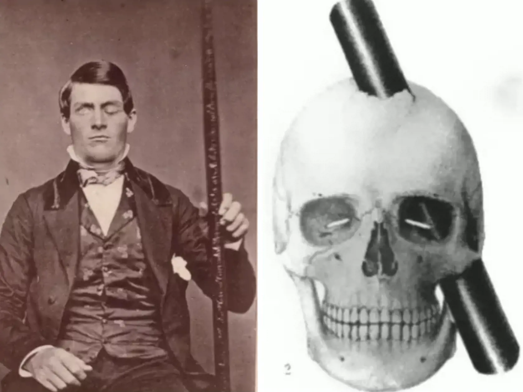 Phineas Gage mal v roku 1848 len 25, keď sa hlavou napichol na kovovú tyč, ktorá prešla jeho mozgom. Akokoľvek neskutočne to znie, prežil, no jeho priatelia sa zhodovali, že od incidentu sa zmenil na nepoznanie. Ako povedal Heath Ledger alias Joker v Temnom rytierovi: „Čo ťa nezabije, to ťa spraví čudnejším.“ Z kedysi milého Phineasa sa stal hulvát bez kúska empatie. Teda, niežeby nás nenahnevalo, ak by sa nám mozgom prehnal kus kovu, no podľa psychológov išlo o prvý zdokumentovaný prípad, kedy bola zmena osobnosti naviazané priamo na poškodenie mozgu.