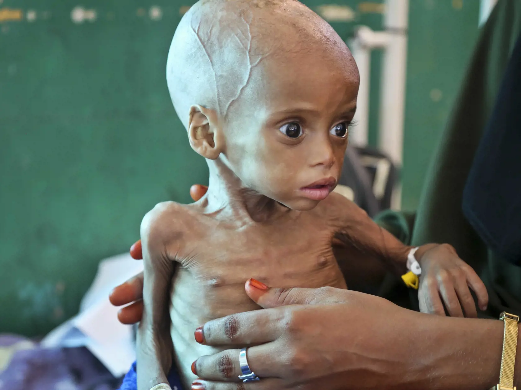 Akútne podvyživené dieťa v Afrike: Rekordných 45 miliónov ľudí v južnej časti Afriky môže čeliť vážnemu nedostatku potravín. Počas vegetačného obdobia panuje v centrálnych a západných oblastiach najhoršie sucho za uplynulých 35 rokov.