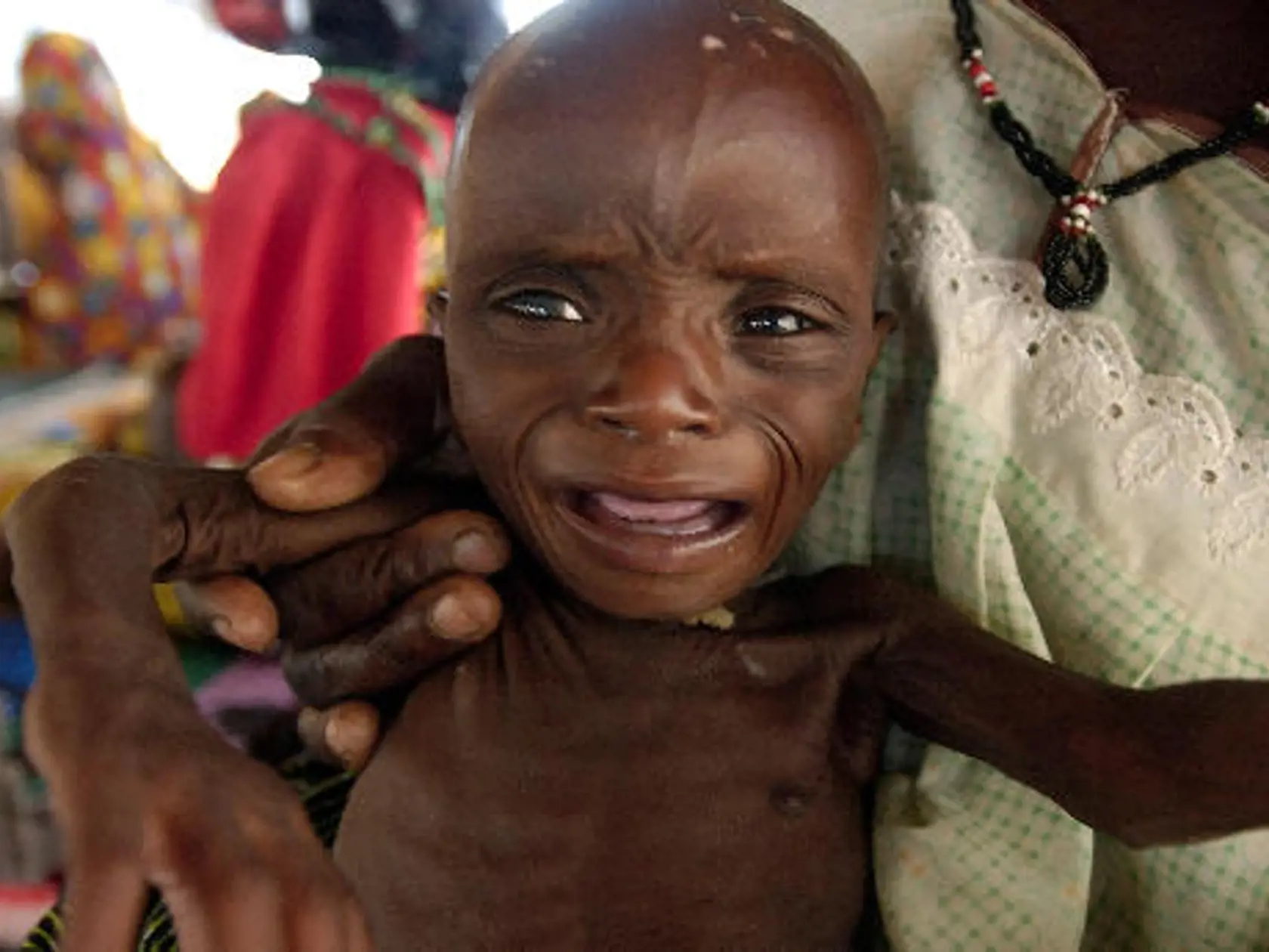 (dpa) - A child suffering from severe malnutrition cries in the therapeutic feeding center of the humanitarian Organisation 'Medecins sans frontieres' (physicians without frontiers) in Maradi , Niger, 15 August 2005. Famine is a perennial problem in Niger, Mali, Mauritania and Burkina Faso and was compounded by a locust invasion last year followed by drought. The U.N. says millions now face severe food shortages. Photo: Marcel Mettelsiefen