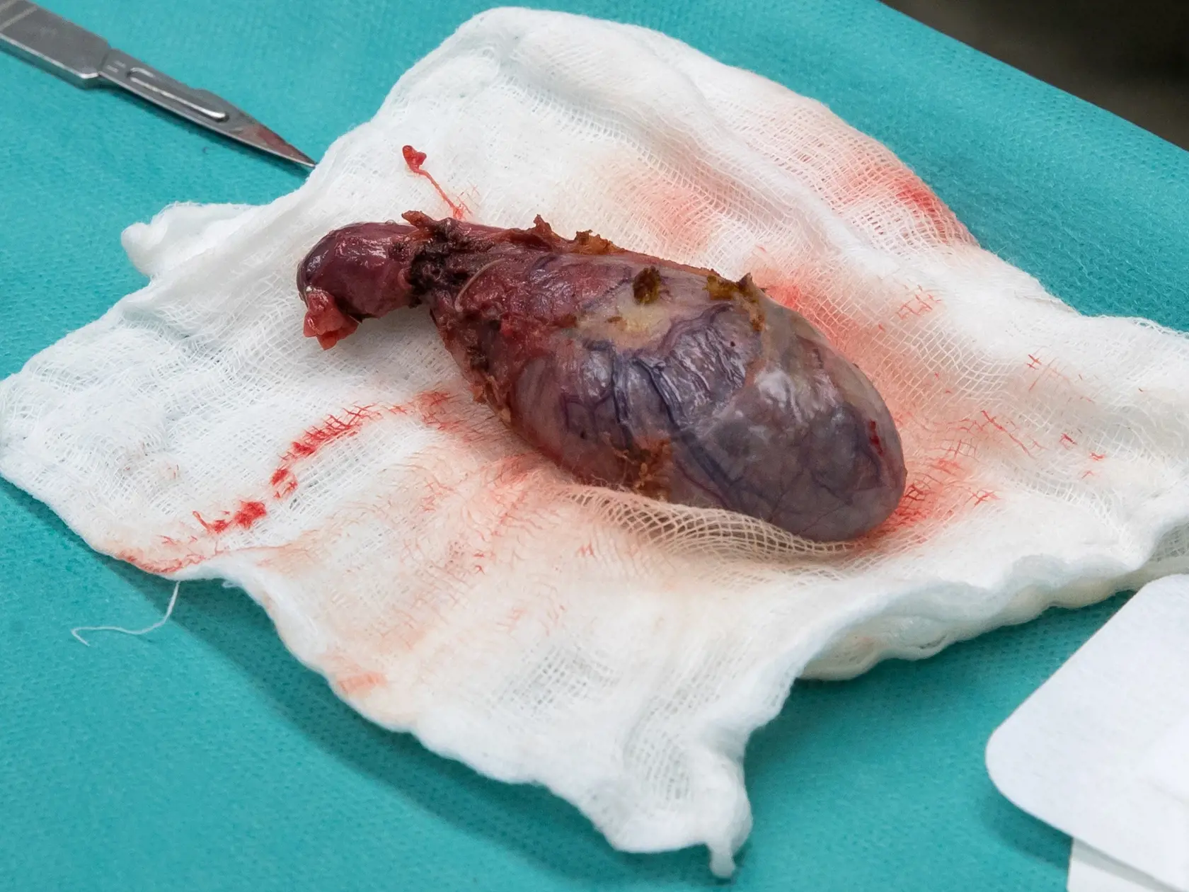 Laparoskopická operácia odstránenia žlčníka na klinike jednodňovej chirurgie REVIVE v Bratislave.
