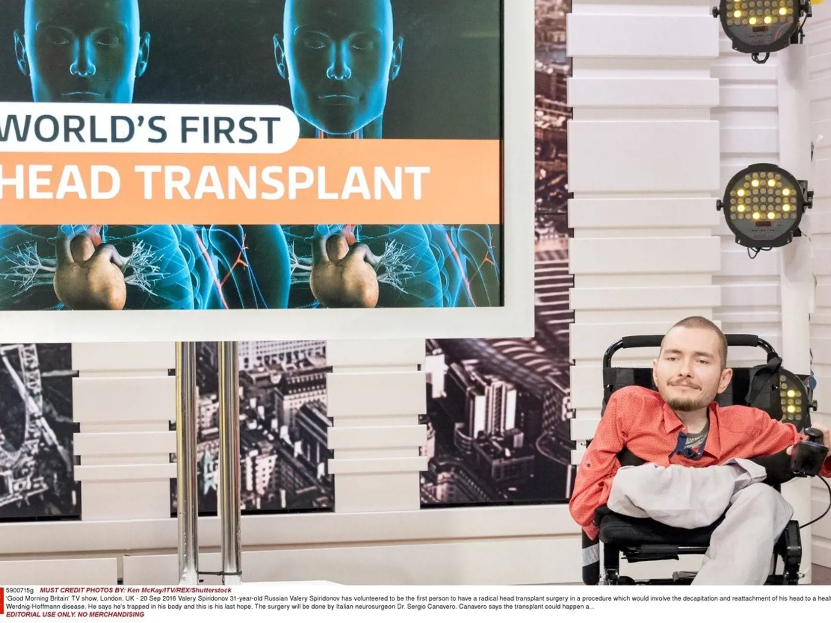 Spiridonov dúfa, že transplantácia hlavy mu dopomôže k epšiemu životu.