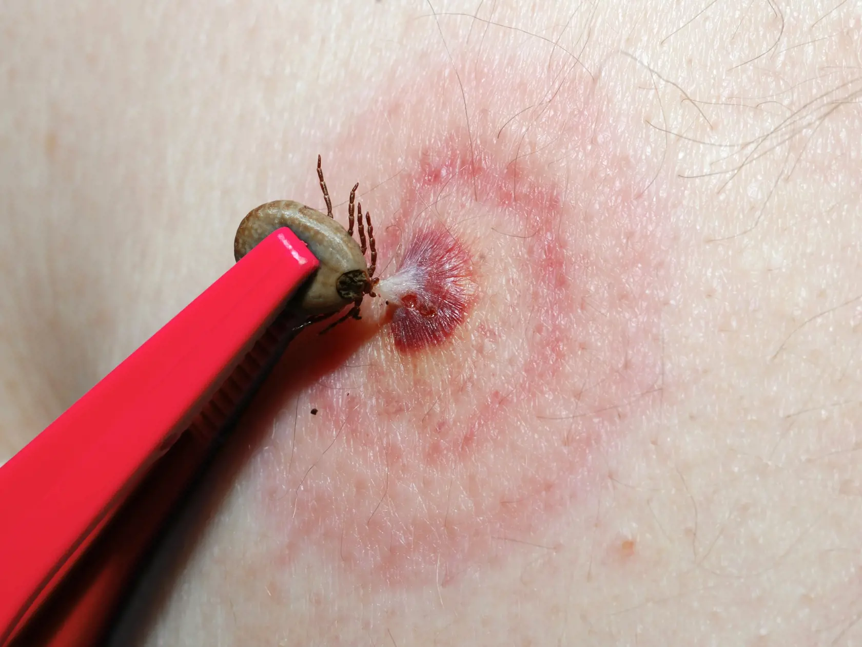 Kliešťa treba správne vybrať z pokožky, hlavička nesmie ostať vnútri.