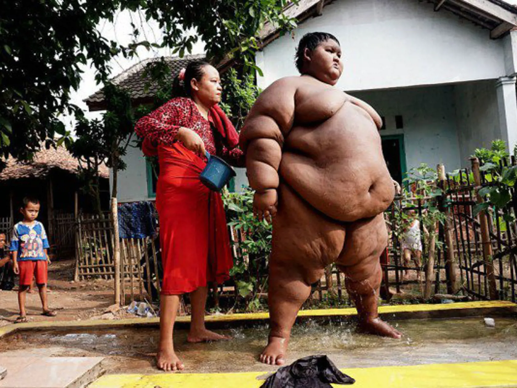 Indický chlapec Arya Permana vážil v roku 2016 desivých 192 kilogramov. V tom čase mal iba 10 rokov a problém mu robili bežné veci, ako chodiť do školy, kúpať sa alebo sa posadiť.