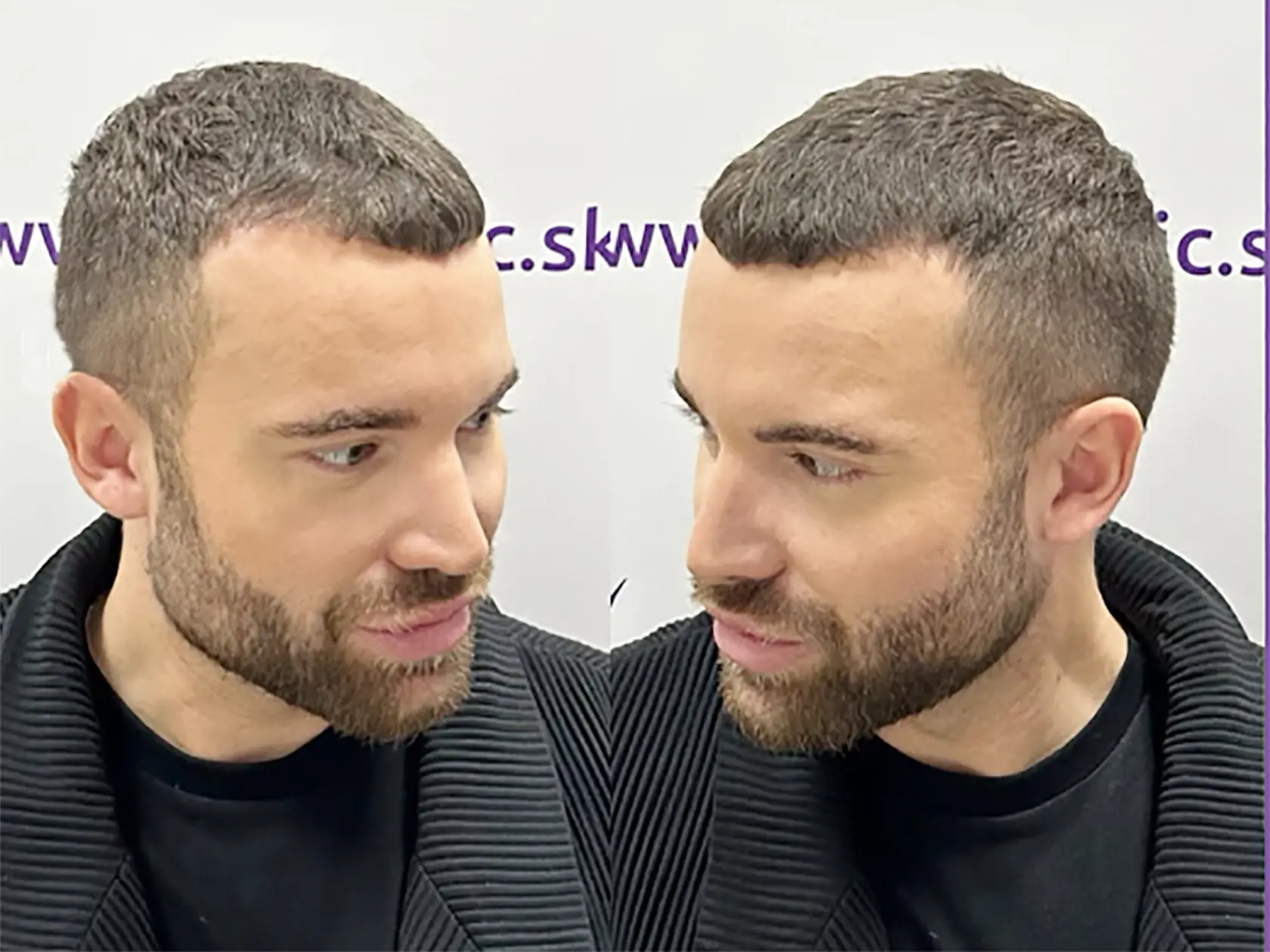 Vizážista Milan Švingál podstúpil zákrok a následne to odporučil aj Slávikovi.