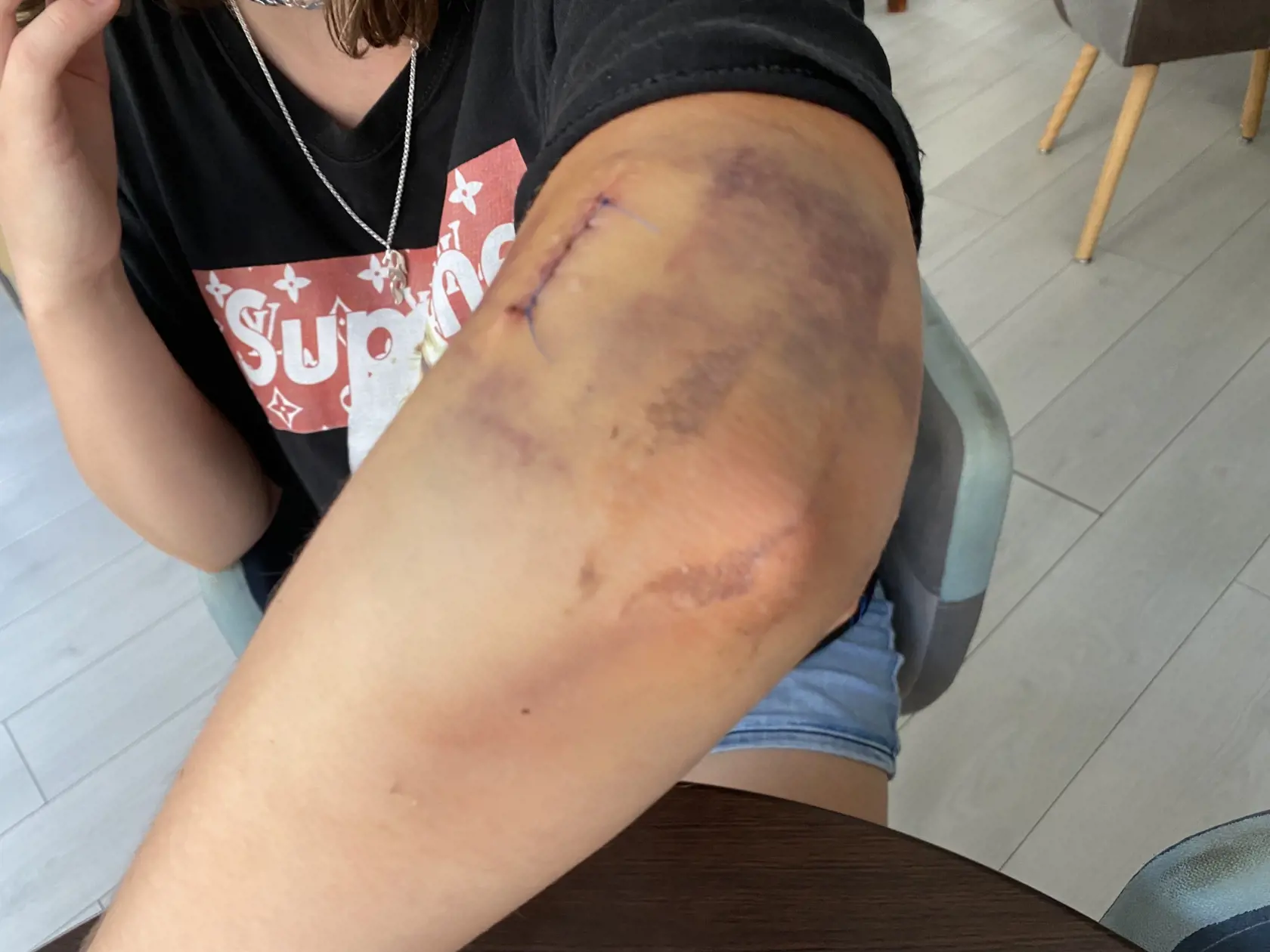 Lakeť po troch operáciách. Viktórii ho podľa jej slov zlomil jej bývalý priateľ, s ktorým sa rozišla.
