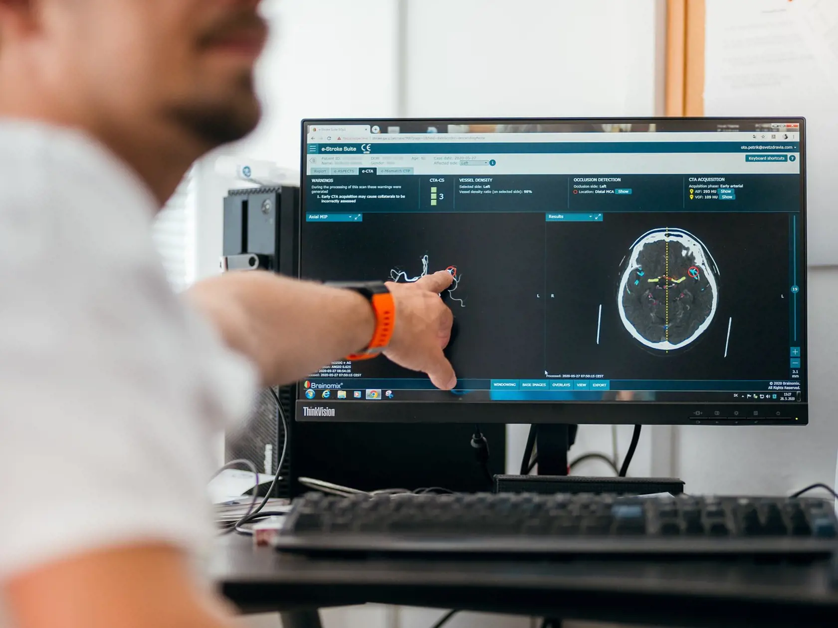 Hoci softvér lekára nenahrádza, poskytuje mu veľmi dôležitý druhý názor a informácie navyše, ktoré dokážu byť pri diagnostike veľmi nápomocné a pomáhajú lekárovi rýchlejšie sa rozhodnúť.