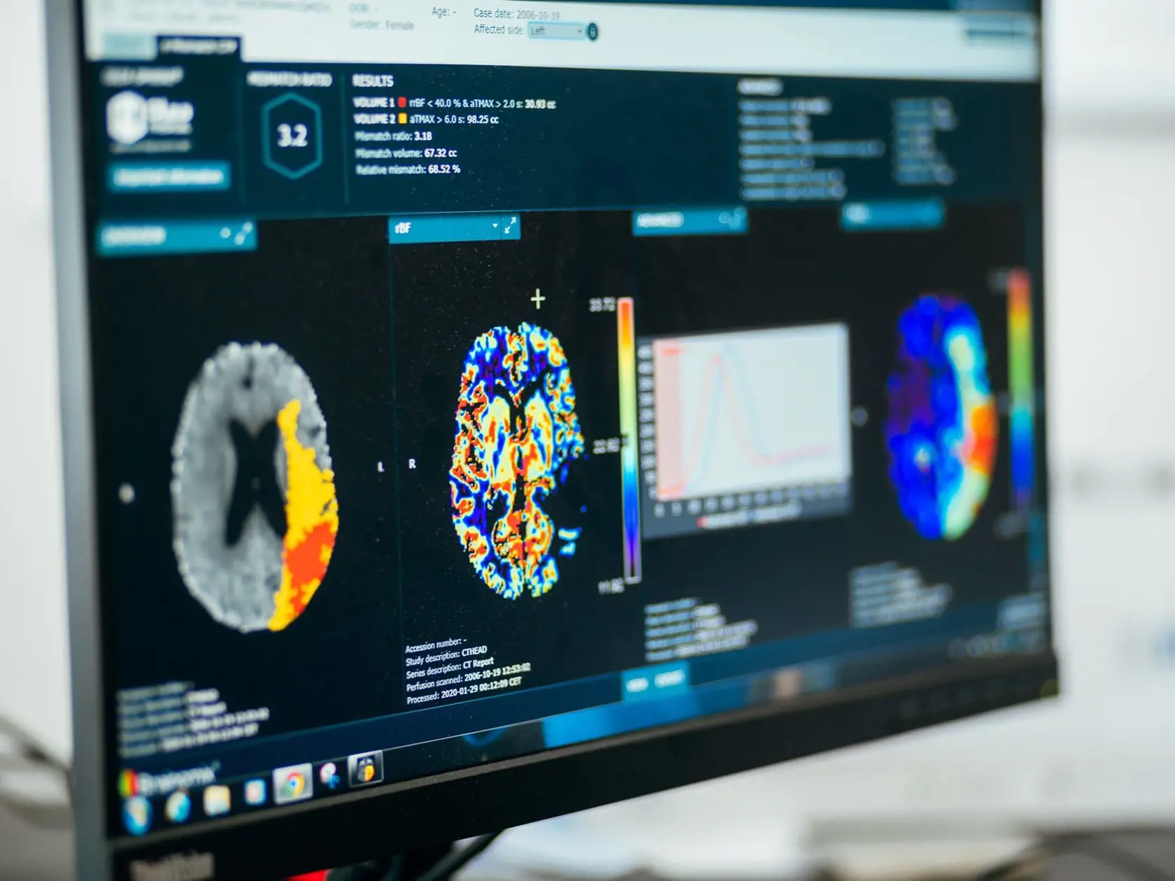 Hoci softvér lekára nenahrádza, poskytuje mu veľmi dôležitý druhý názor a informácie navyše, ktoré dokážu byť pri diagnostike veľmi nápomocné a pomáhajú lekárovi rýchlejšie sa rozhodnúť.