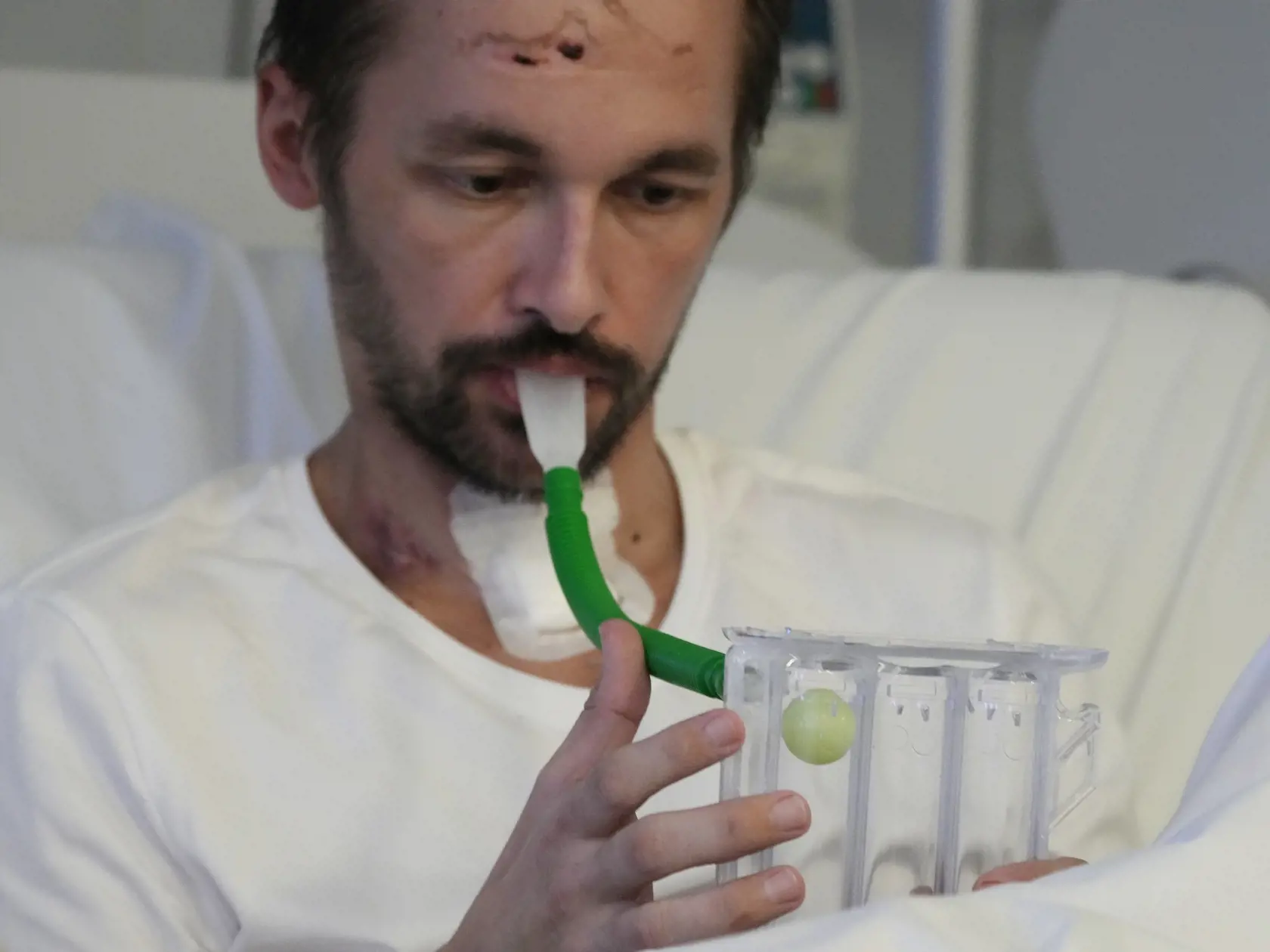 Štúdia ukázala, že najmä pacienti s vážnym priebehom boli vystavení následnému riziku krvných zrazenín.