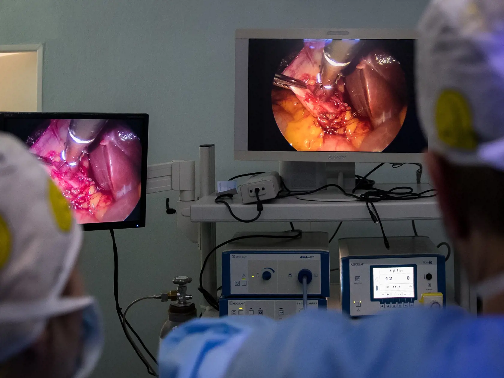 Laparoskopická operácia odstránenia žlčníka na klinike jednodňovej chirurgie REVIVE v Bratislave.