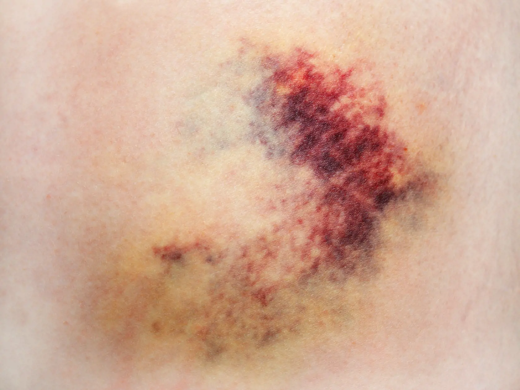 Bruise,On,White,Skin.,Close-up,Photo