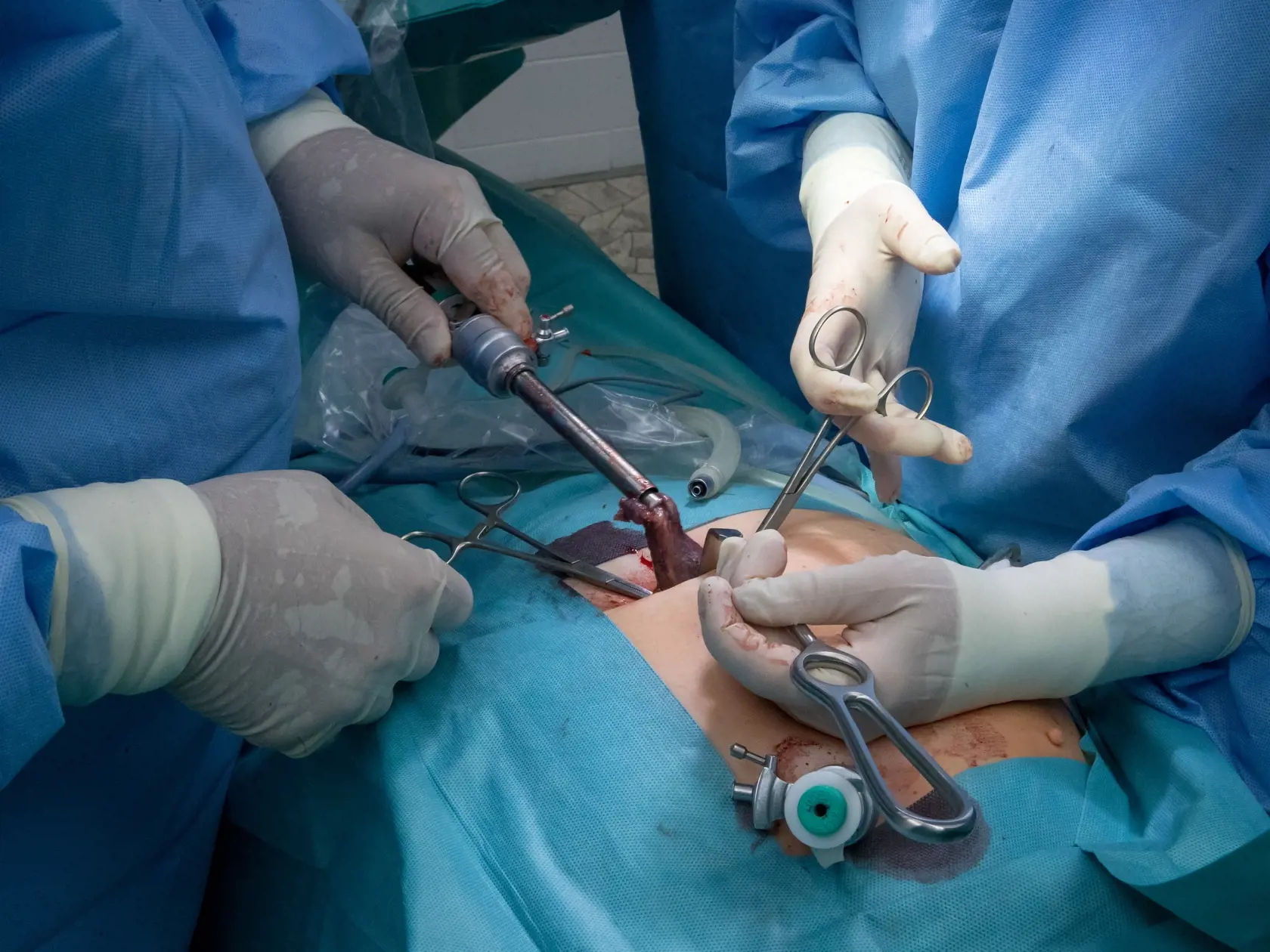 Laparoskopická operácia odstránenia žlčníka na klinike jednodňovej chirurgie REVIVE v Bratislave.