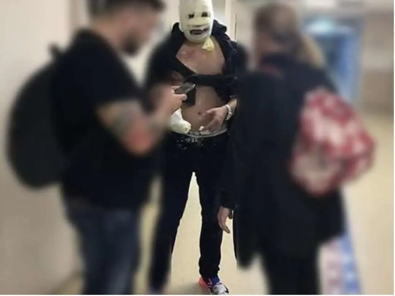 Priateľ českej youtuberky Viktor (na foto v strede) sa popáleninám druhého stupňa taktiež nevyhol, no ako sám hovorí, jeho partnerka je na tom oveľa, oveľa horšie.