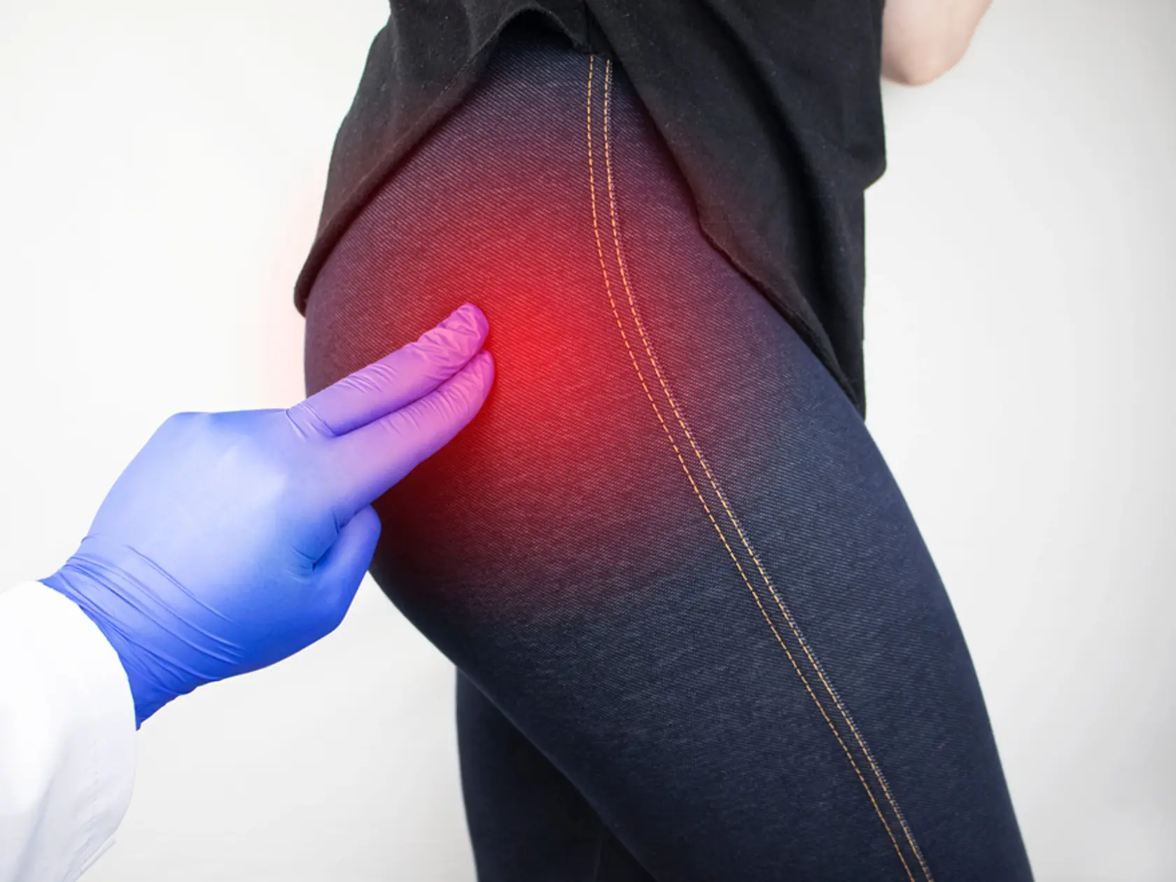 Za bolesťou zadku, bedrového kĺbu može byť aj piriformisový syndróm, teda uskočenie sedacieho nervu, bedrová osteochondróza alebo ischias.