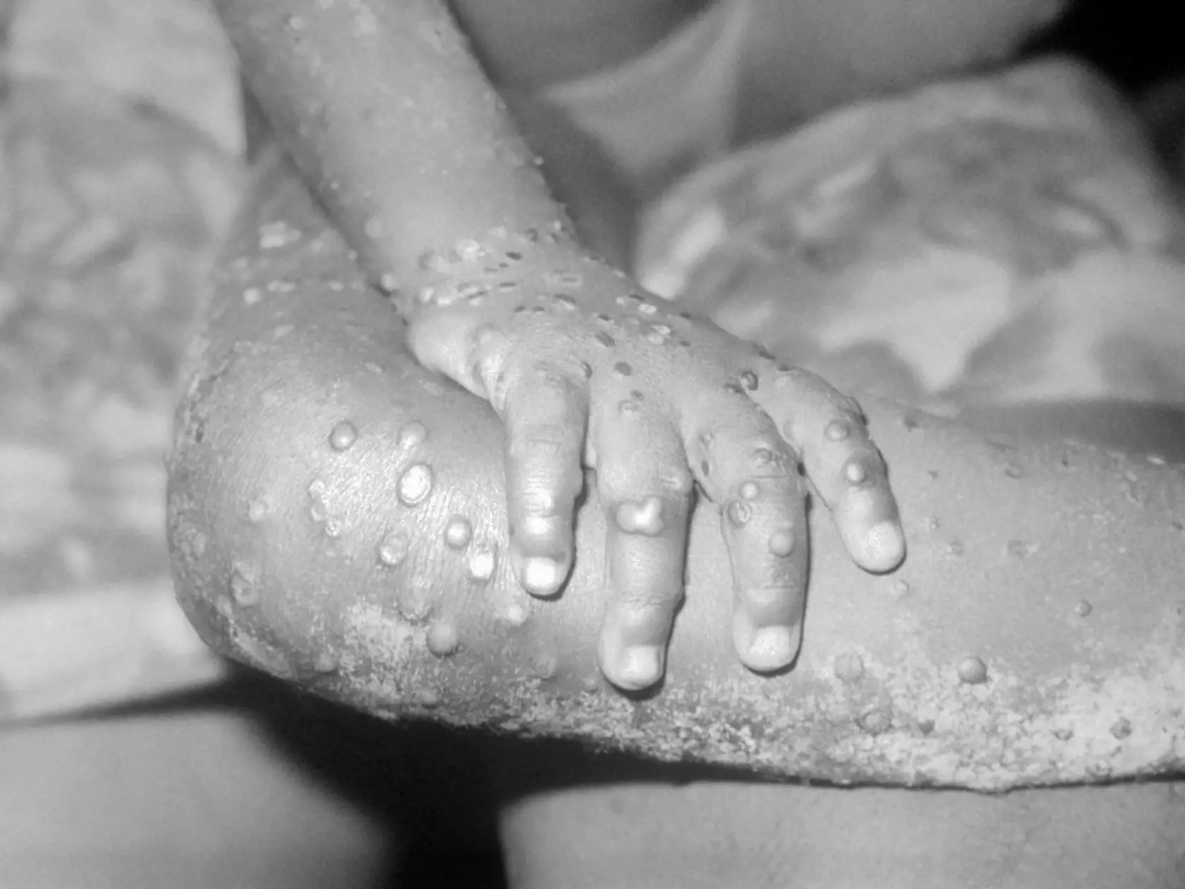 Fotografia opičích kiahní z roku 1971, kedy bolo ochorenie prvýkrát zaznamenané u človeka.