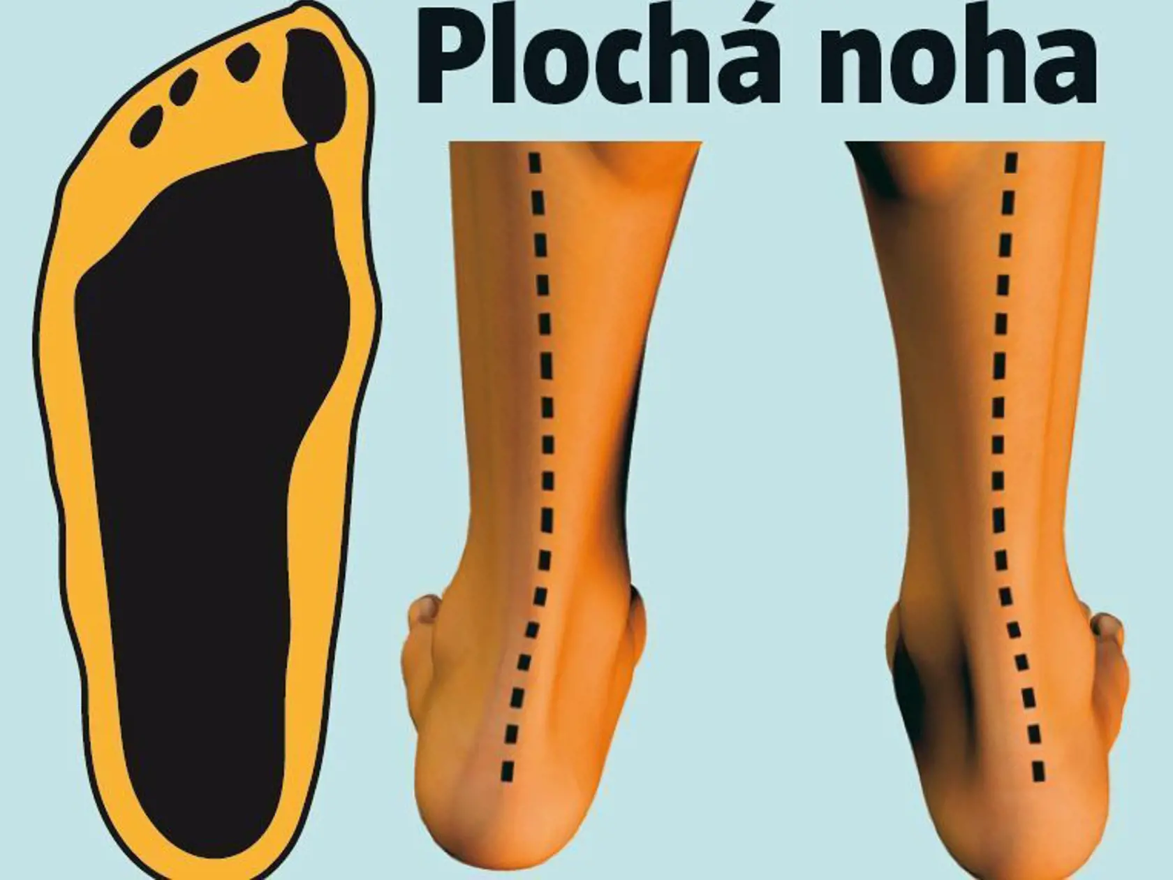 Plochá noha
