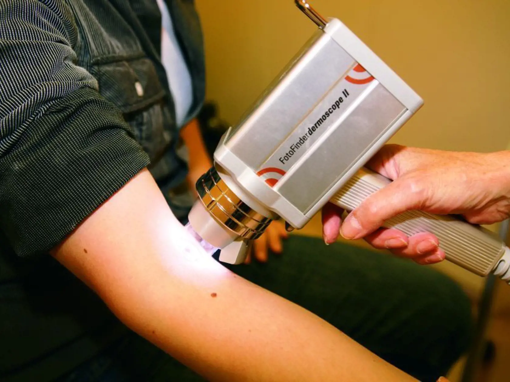 1. Vyšetrenie znamienka digitálnym dermatoskopom.