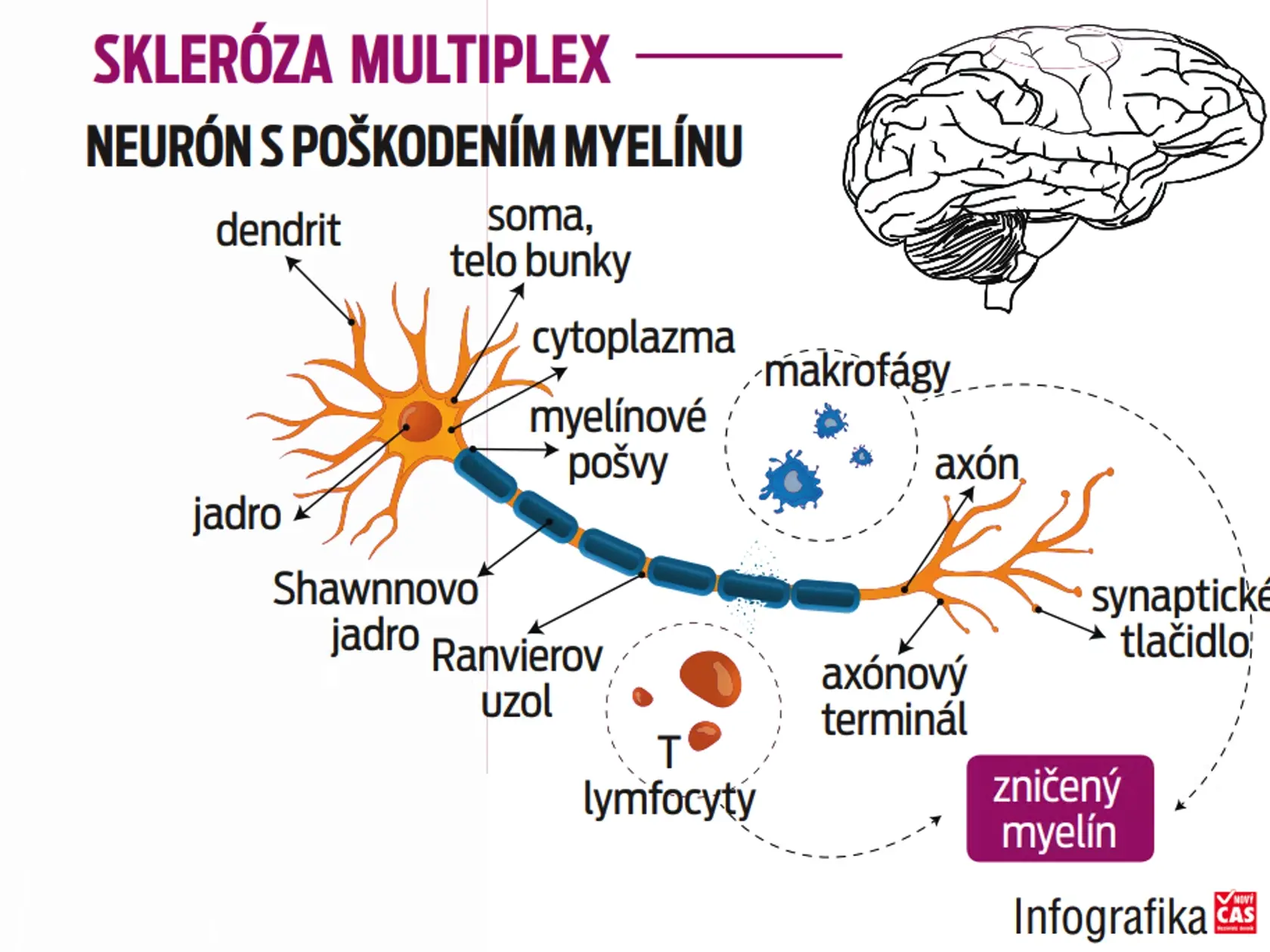 Mýtus: Je to ochorenie, ktorého výsledkom je život na invalidnom vozíku, a skorá smrť.
Realita: Ide síce nevyliečiteľné ochorenie, ale jeho progresia sa dá efektívne oddialiť o niekoľko desaťročí a pacient pri dobrej liečbe môže od prvých príznakov veľmi dlho viesť plnohodnotný život. 

Mýtus: Nedá sa liečiť.
Realita: Existuje množstvo chorobu modifikujúcich liekov, ktoré umožňujú „ušiť“ pacientovi liečbu na mieru. Moderná medicína dokáže spomaliť rozvoj ochorenia.