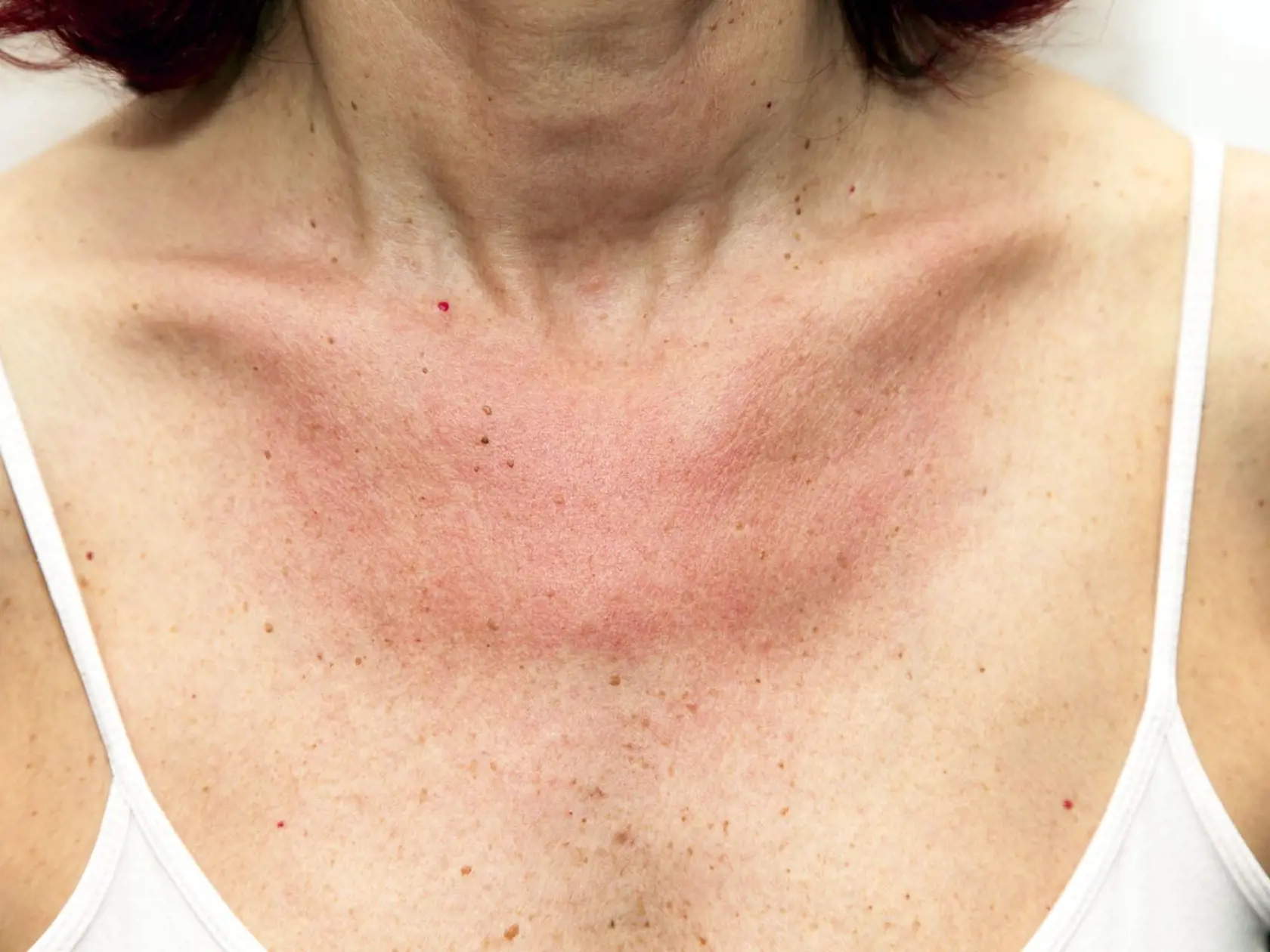 Alergia na slnko sa môže prejaviť aj vyrážkami, ktoré často nepríjemne svrbia.