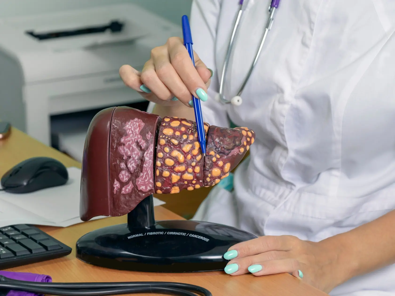 Stukovatenie pečene hrozí viac ženám po menopauze.