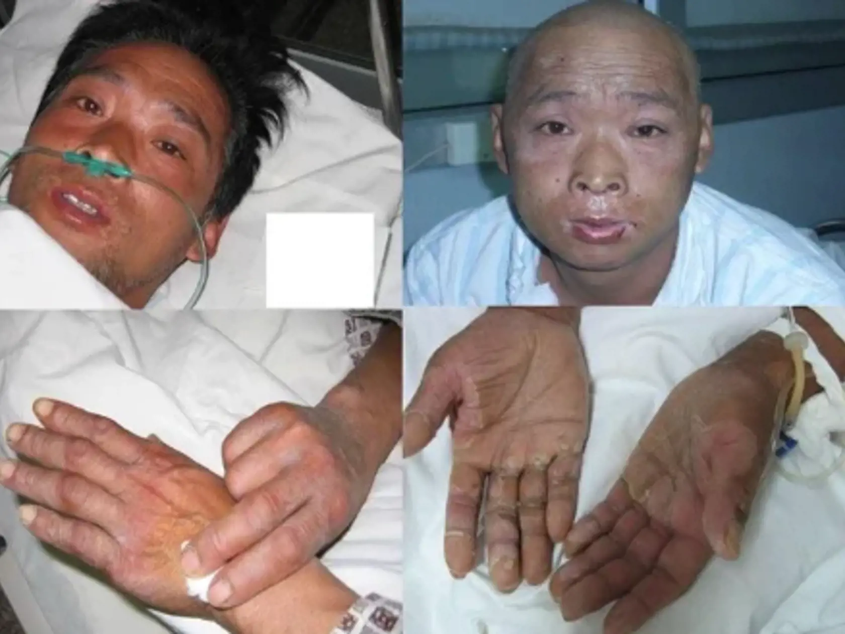 Desivý a bolestivý osud postihol Hisashiho Ouchiho, pracovníka na experimentálnom reaktore v japonskej prefektúre Ibaraki. Ouchi a dvaja spolupracovníci boli požiadaní, aby zmiešali 2,4 kilogramu uránu s kyselinou dusičnou, pričom ignorovali bezpečnostné postupy a zmiešali ho vo vedre z nehrdzavejúcej ocele.