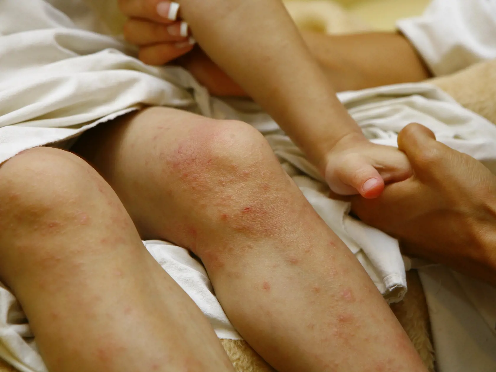 Odborný detský liečebný ústav pre liečbu dermatóz a respiračných ochorení v Trávnici. Atopický ekzém.