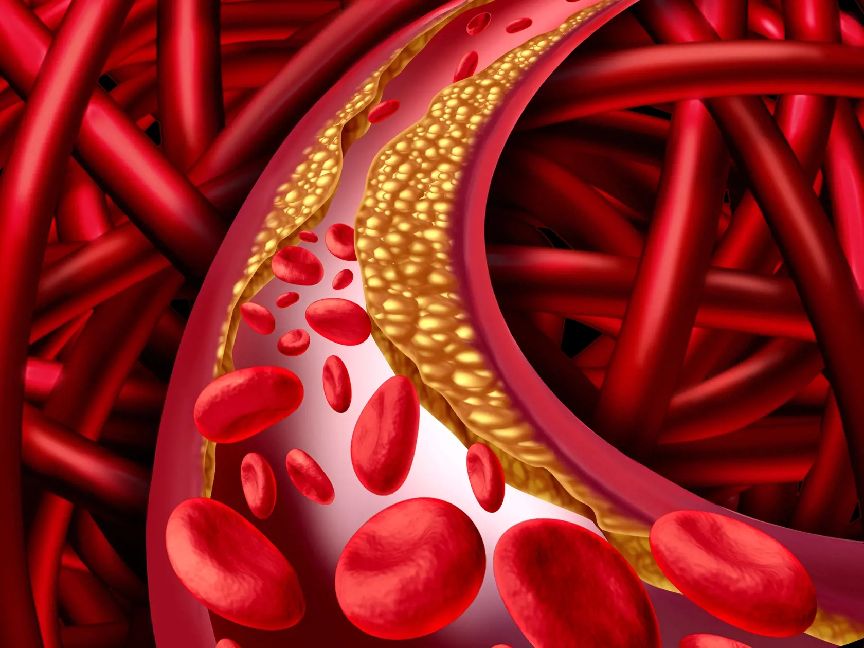 Vysoký cholesterol sa podieľa na upchávaní ciev.