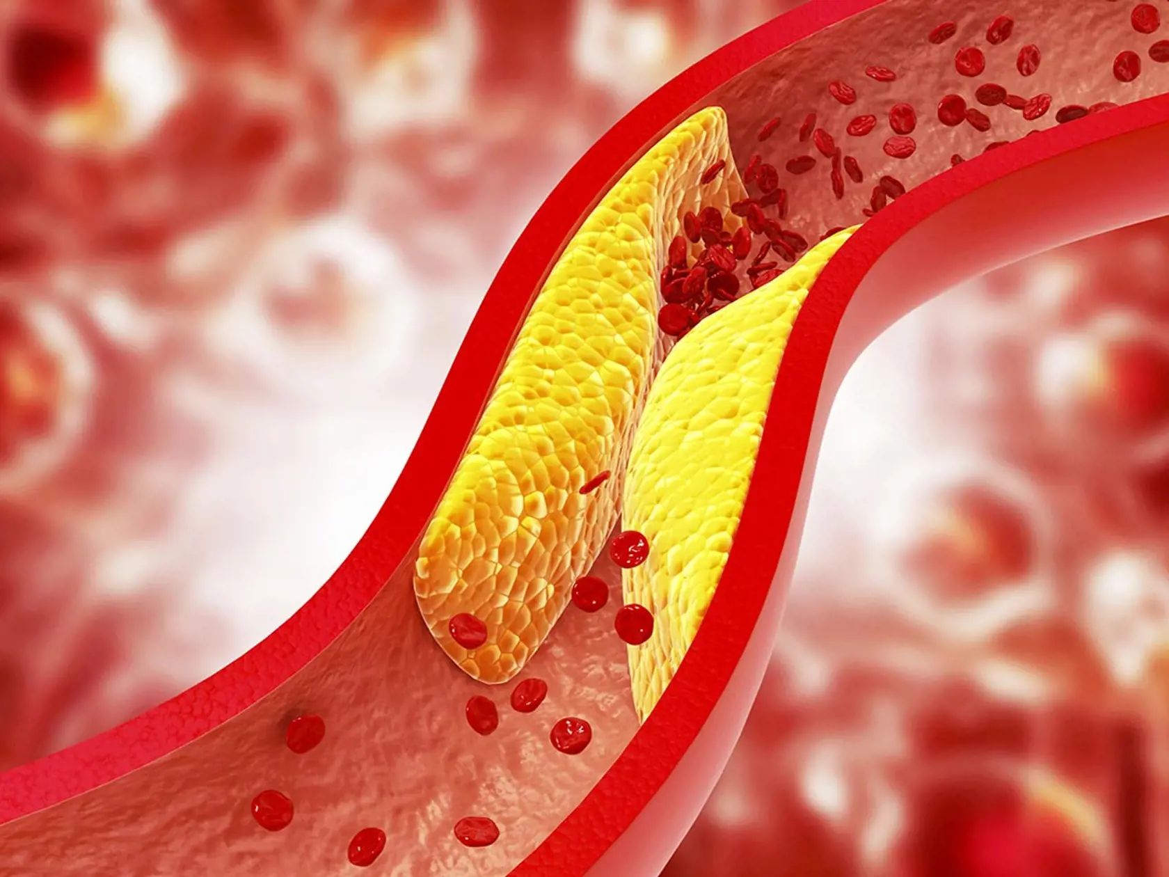Za upchaté cievy môže hlavne zlý cholesterol.