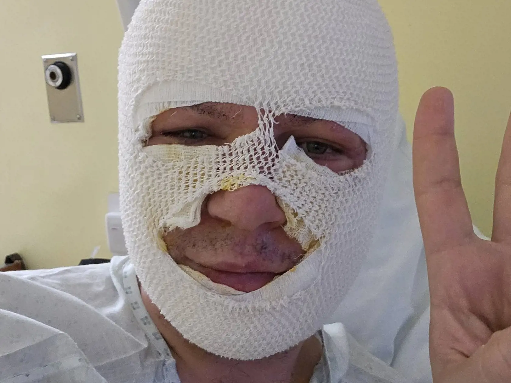 Miroslav Žiak si pri zapalovaní biokrbu spôsobil popáleniny.
