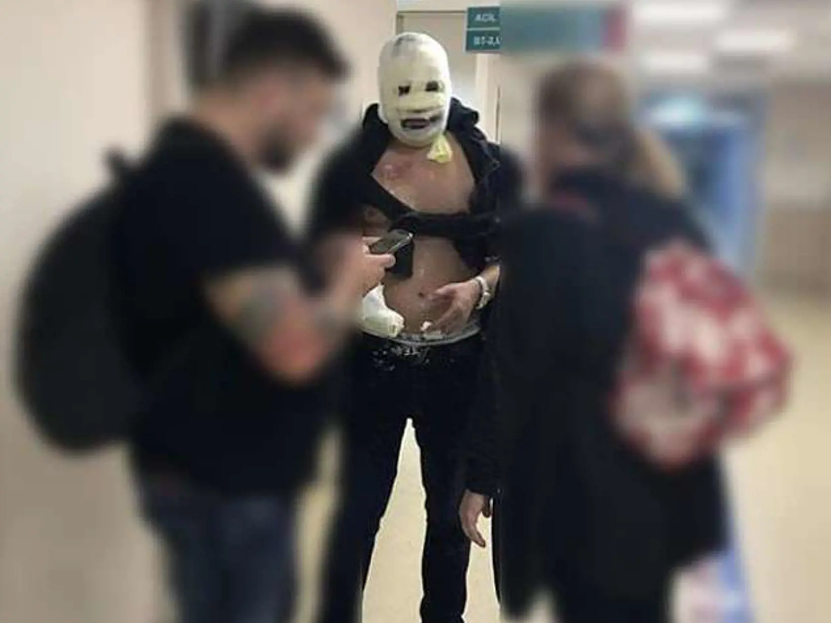 Priateľ českej youtuberky Viktor (na foto v strede) sa popáleninám druhého stupňa taktiež nevyhol, no ako sám hovorí, jeho partnerka na tom bola oveľa, oveľa horšie.