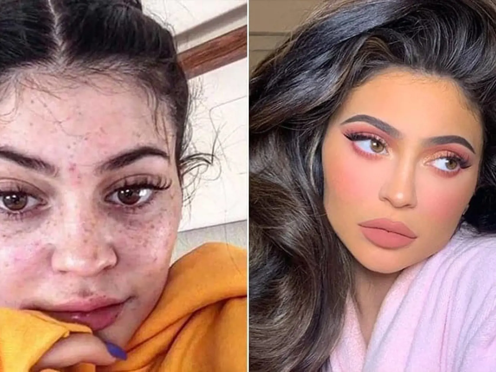 Kylie Jenner sa na Instagrame prezentuje ako dokonalá bábika. Skutočnosť je taká, že aj ona zápasí s problémovou pleťou.