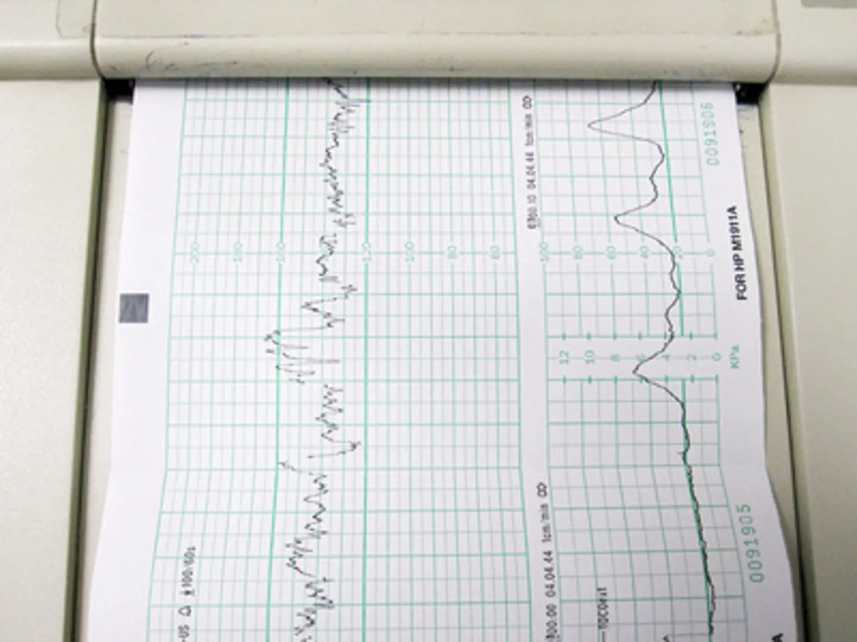 fetus heartbeat and contractions being monitored
