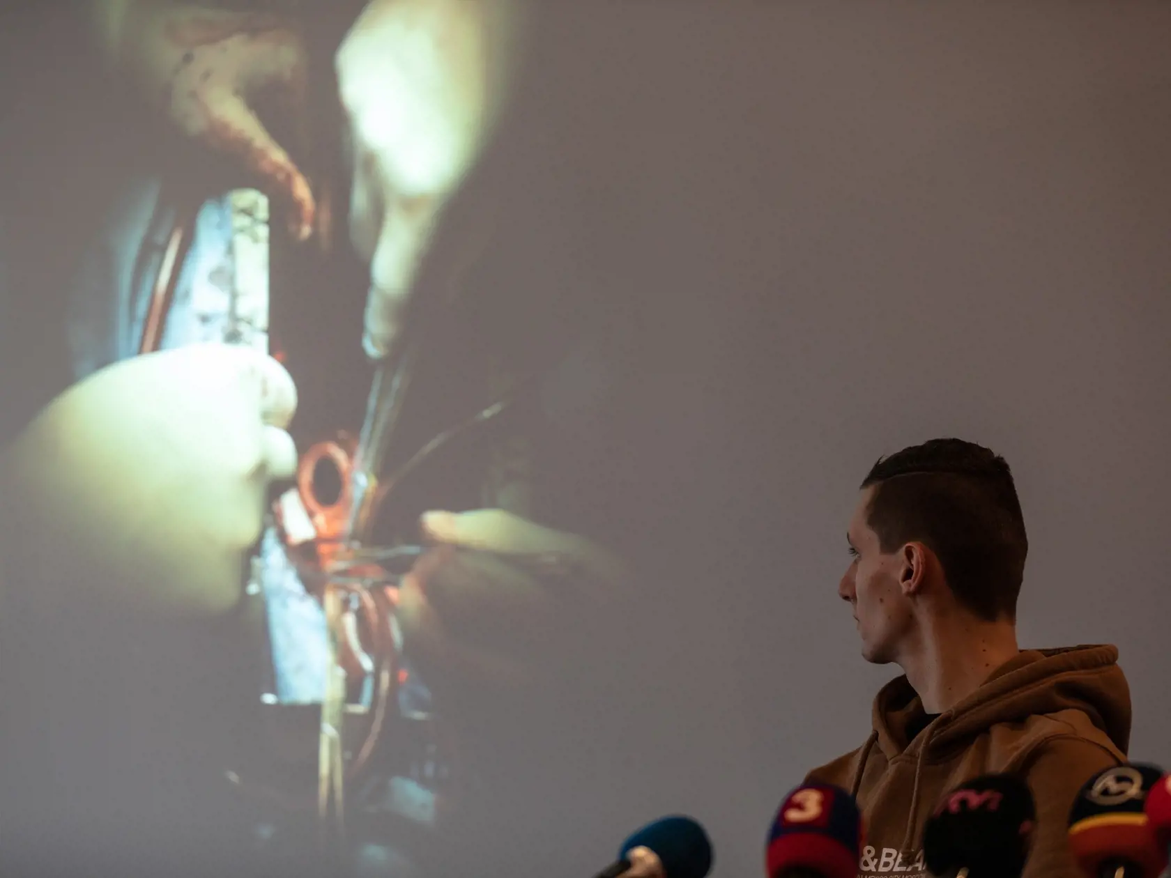 Prvú implantáciu umelého srdca na Slovensku vykonali 1. novembra 2017 v Národnom ústave srdcových a cievnych chorôb v Bratislave, bola to prvá operácia tohto typu v krajinách V4.