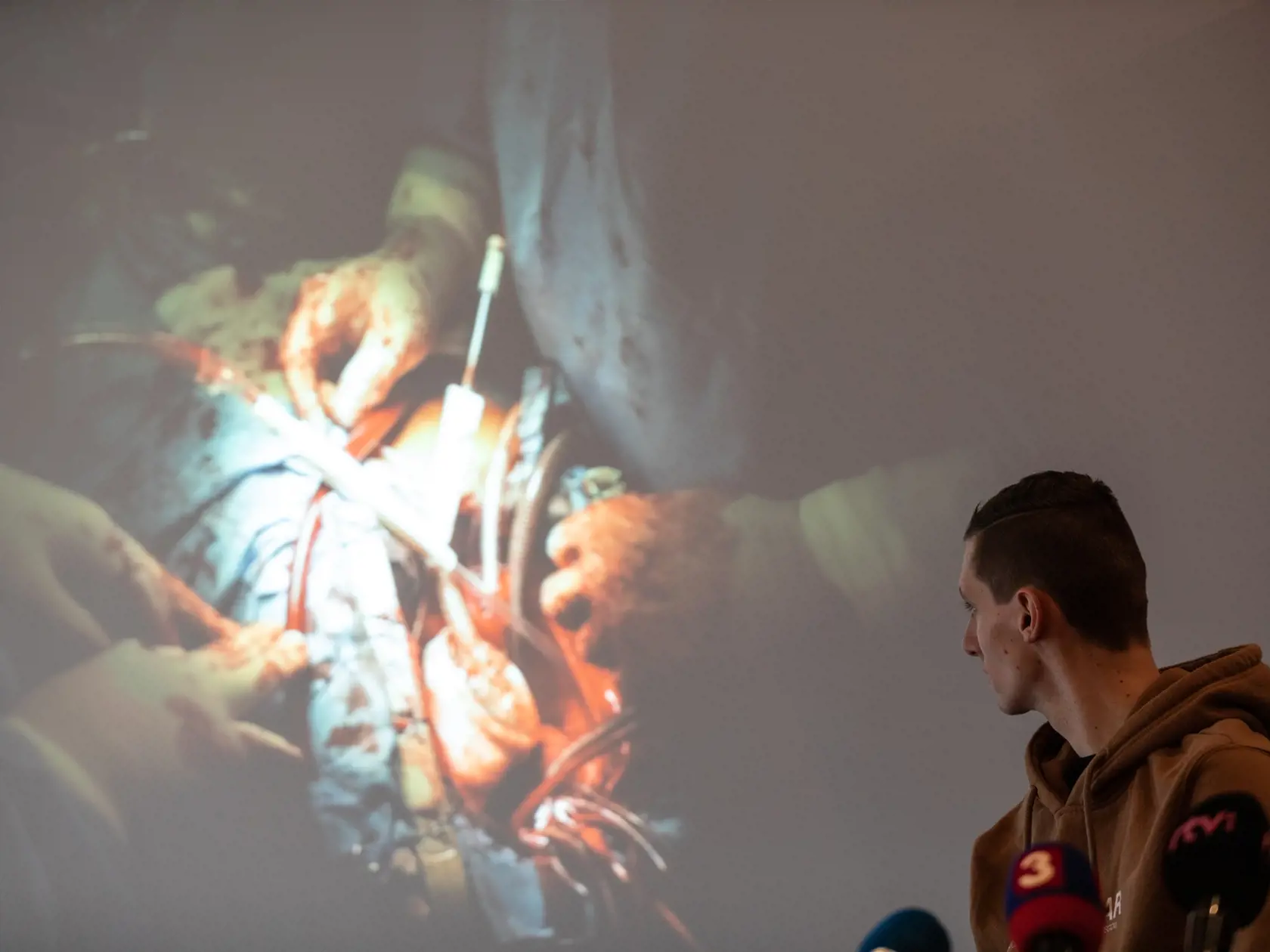 Prvú implantáciu umelého srdca na Slovensku vykonali 1. novembra 2017 v Národnom ústave srdcových a cievnych chorôb v Bratislave, bola to prvá operácia tohto typu v krajinách V4.
