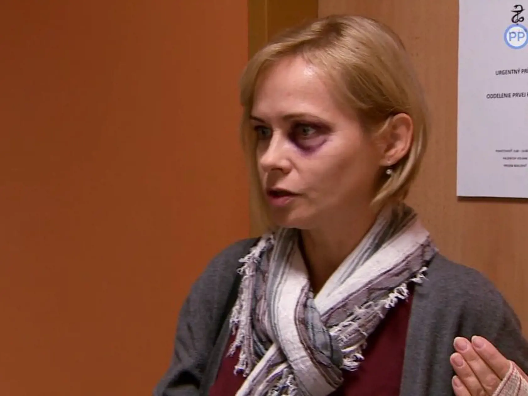 Zuzana Skopálová s modrinou okolo oka.