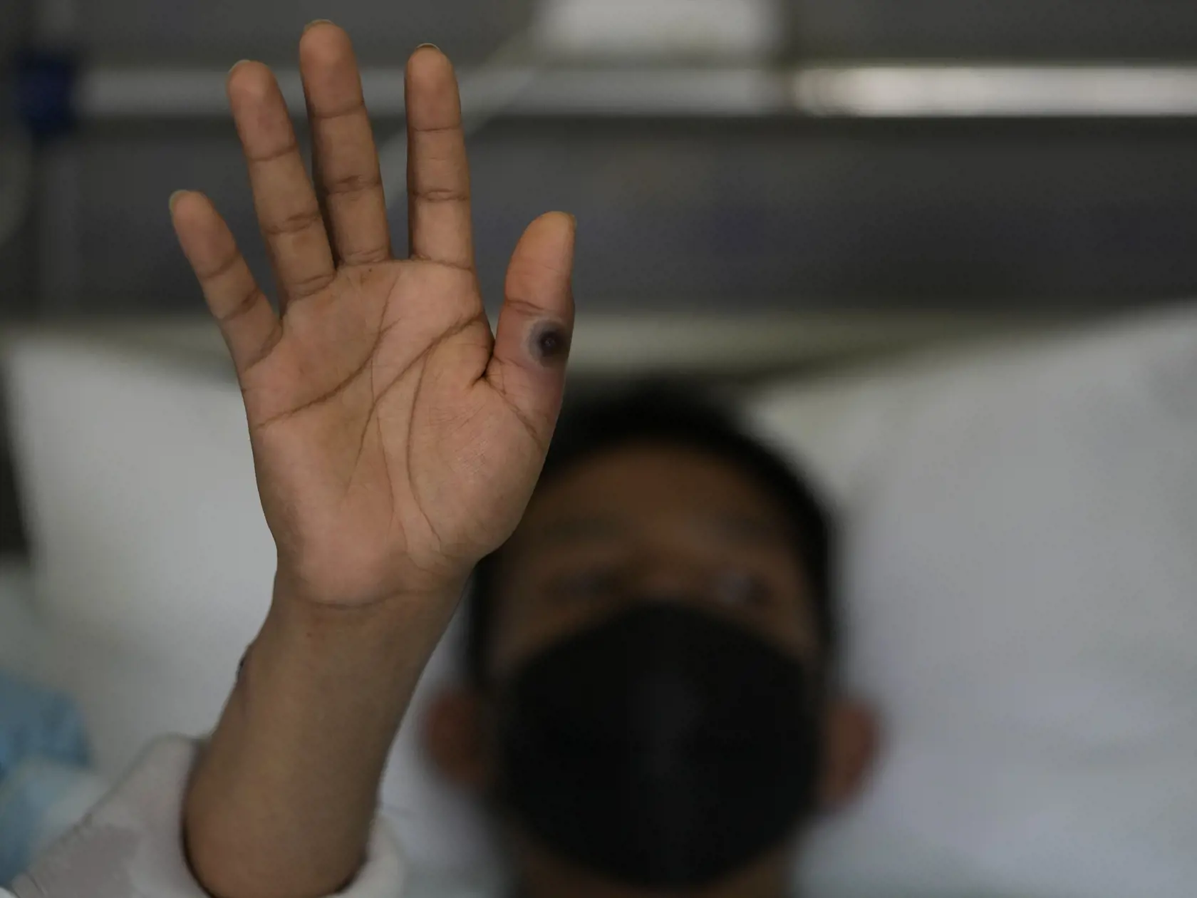 WA 47 Lima - Pacient, ktorý sa lieči na ochorenie opičích kiahní, ukazuje vyrážku na prste v nemocnici v Lime v utorok 16. augusta 2022. FOTO TASR/AP

A patient shows his hands with a sore caused by monkeypox at the Arzobispo Loayza hospital in Lima, Peru, Tuesday, Aug. 16, 2022. (AP Photo/Martin Mejia)