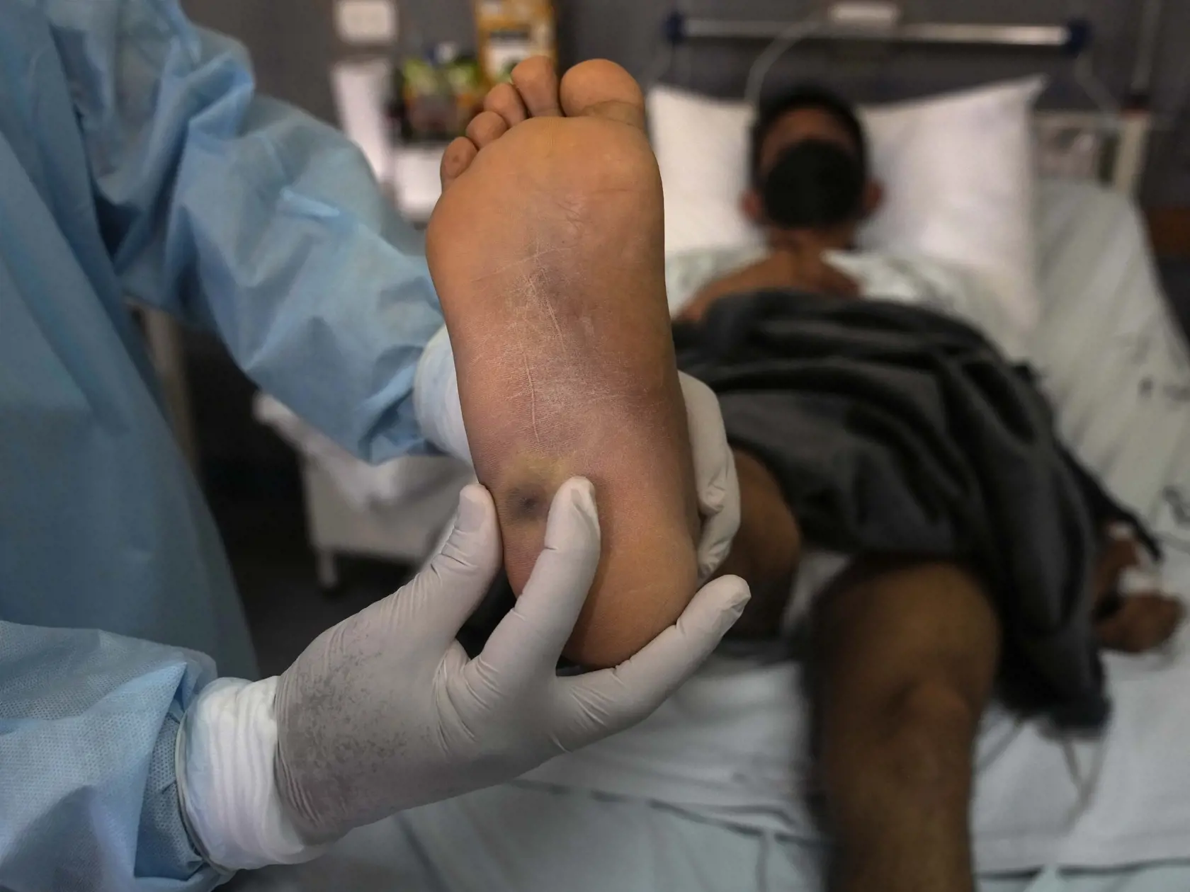WA 45 Lima - Lekár ukazuje vyrážky na nohe pacienta, ktorý sa lieči na ochorenie opičích kiahní v nemocnici v Lime v utorok 16. augusta 2022. FOTO TASR/AP

A doctor shows a monkeypox sore on a patientÂ´s foot at the Arzobispo Loayza hospital in Lima, Peru, Tuesday, Aug. 16, 2022. (AP Photo/Martin Mejia)