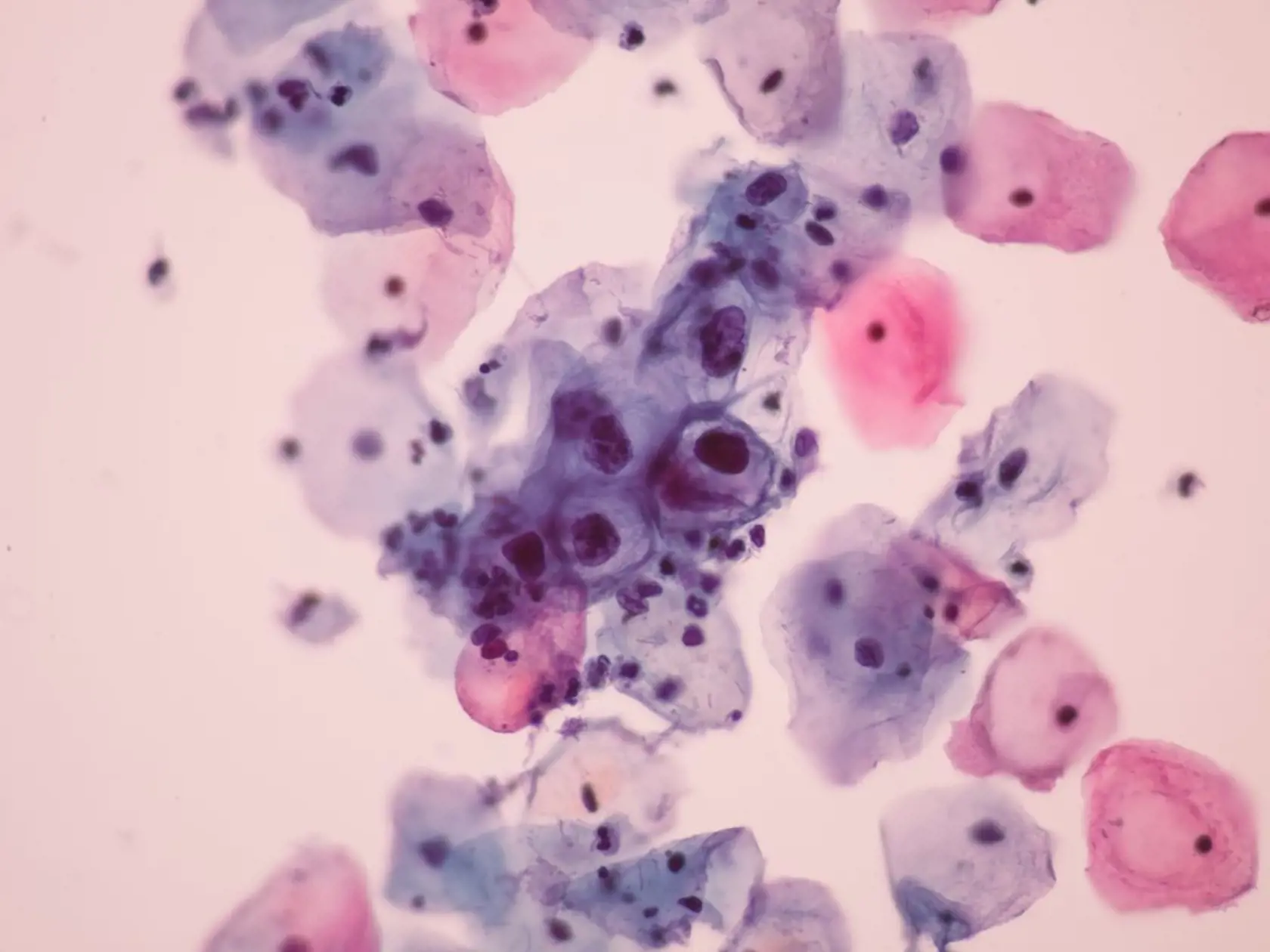 Bunky napadnuté vírusom HPV.