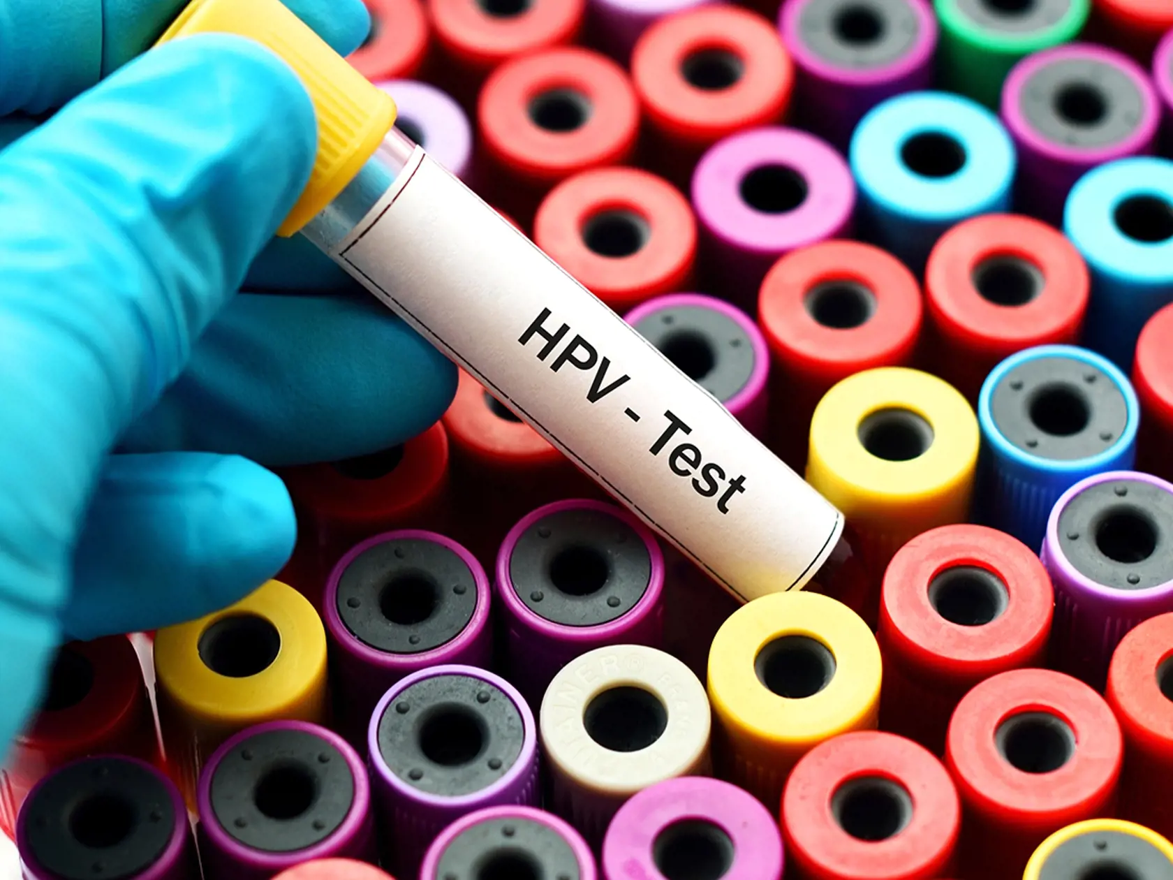 DNA HPV test je v niektorých krajinách prvou voľbou prevencie rakoviny krčka maternice.