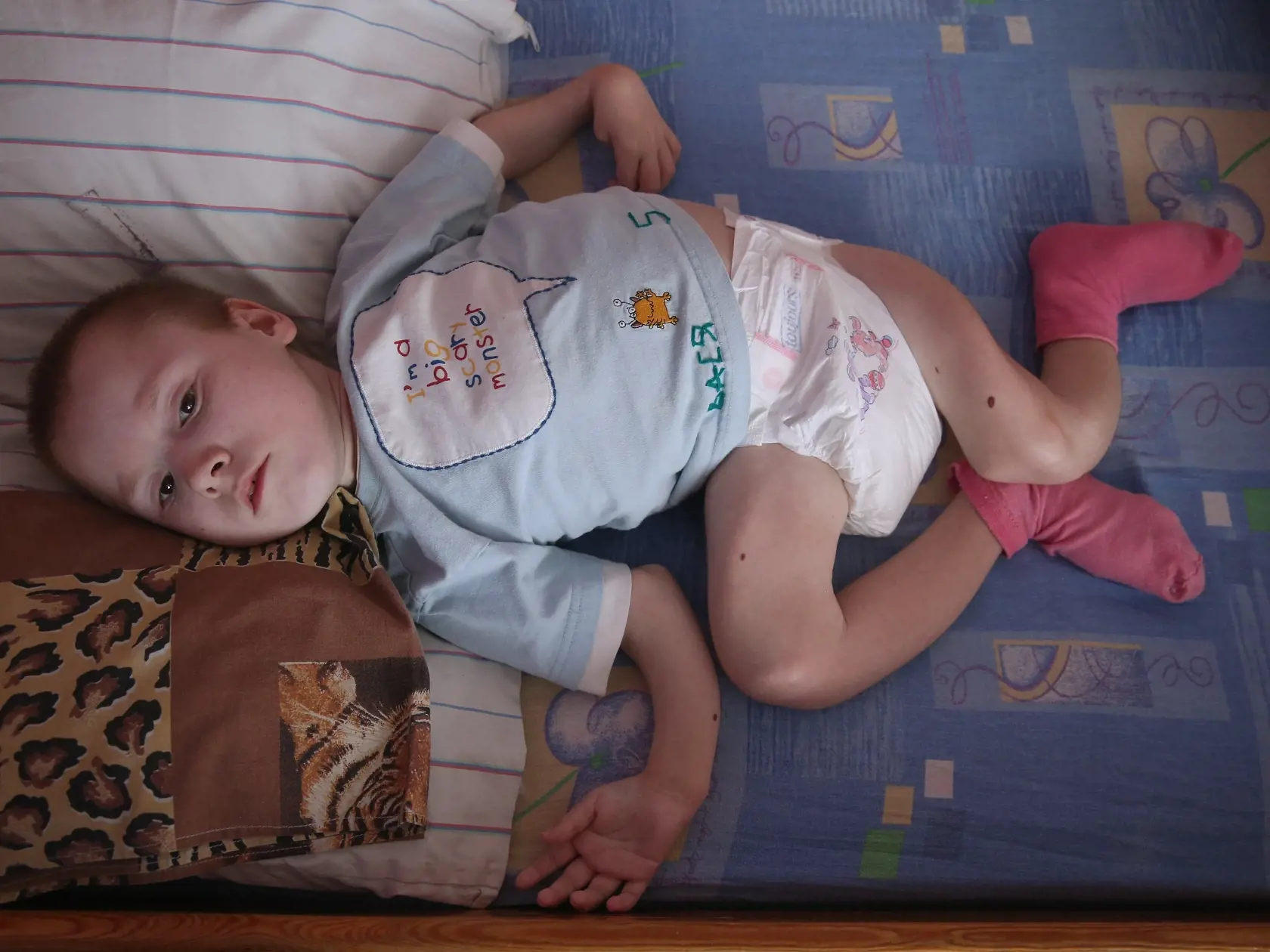 GLUSK, BELARUS - APRIL 03:  Vasilii, 15, who was born with severe birth defects and is the size of a small child, lies in his bed at the Vesnova Home for Invalid Children where his elder brother, who has a similar condition, also receives care on April 3, 2016 in Vesnova village near Glusk, Belarus. Approximately 170 handicapped children and teenagers, many of whom were born with severe birth defects, receive care at the facility located in southen Belarus, not far from zones contaminated by rad