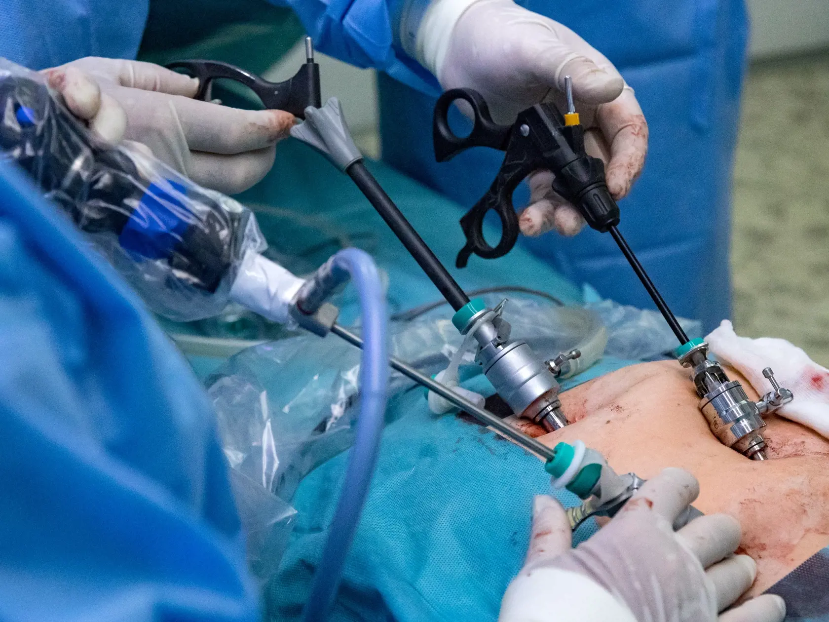 Laparoskopická operácia odstránenia žlčníka na klinike jednodňovej chirurgie REVIVE v Bratislave.