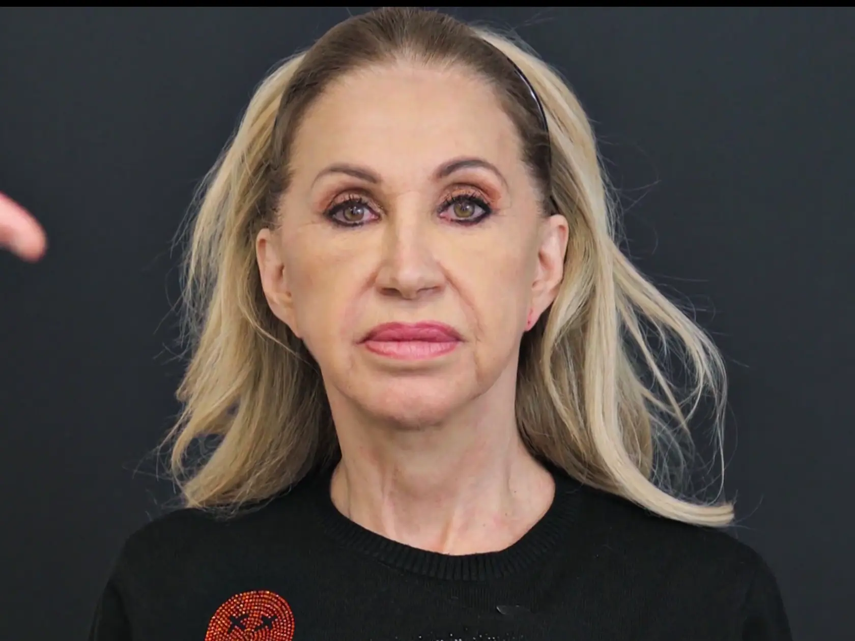 Carmen Geiss výrazne schudla a ovisla jej koža na tvári. Rozhodla sa to vyriešiť faceliftom.